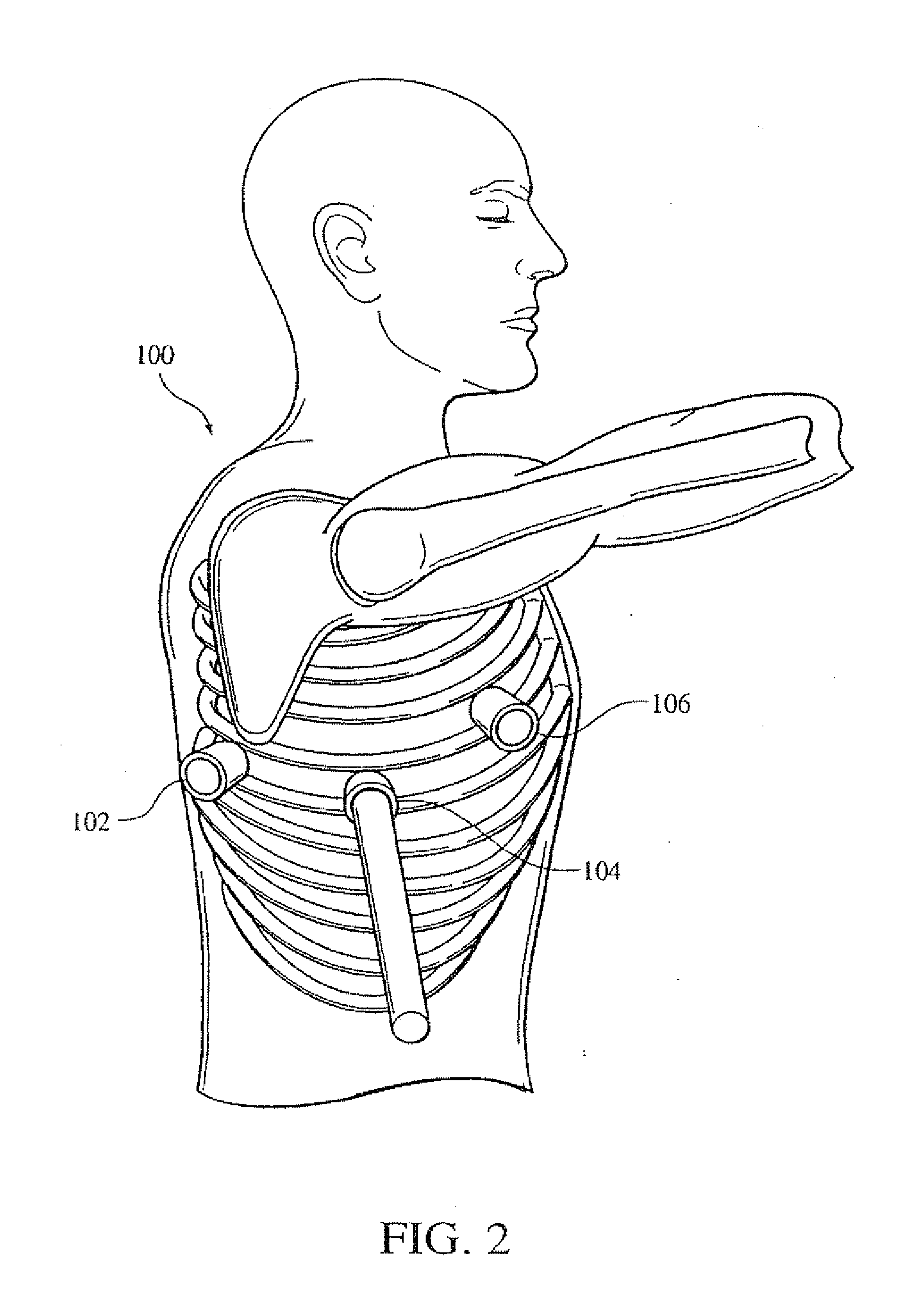 Electrical stimulation of the sympathetic nerve chain