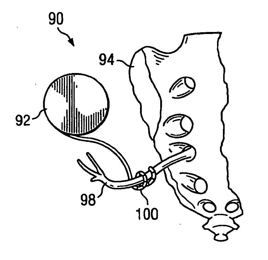 System and method for treatment of sexual dysfunction