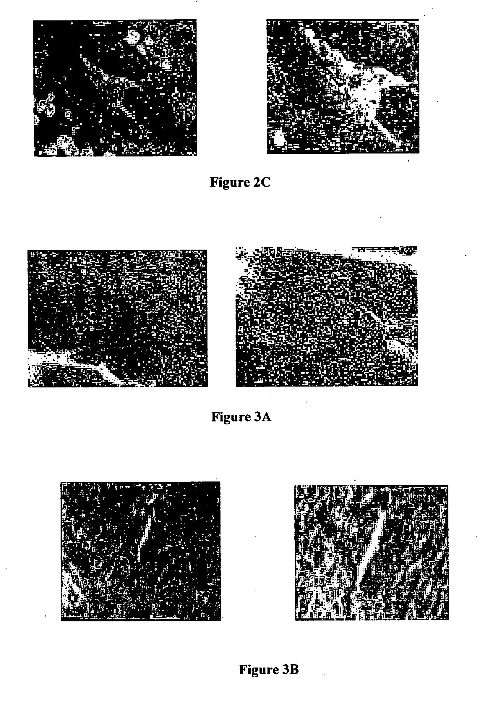 Method, reagent, and device for embolizing blood vessels in tumors with ultrasonic radiation micro-bubble reagent
