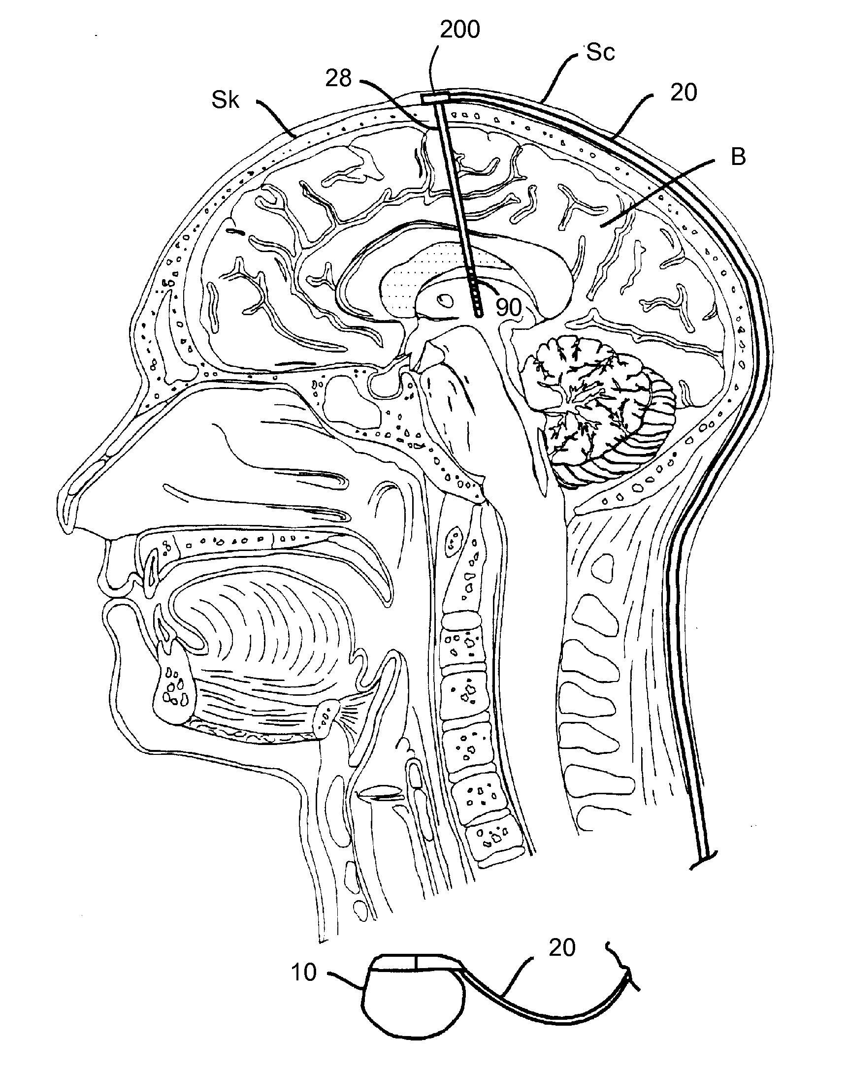 Lead having thin distal end portion