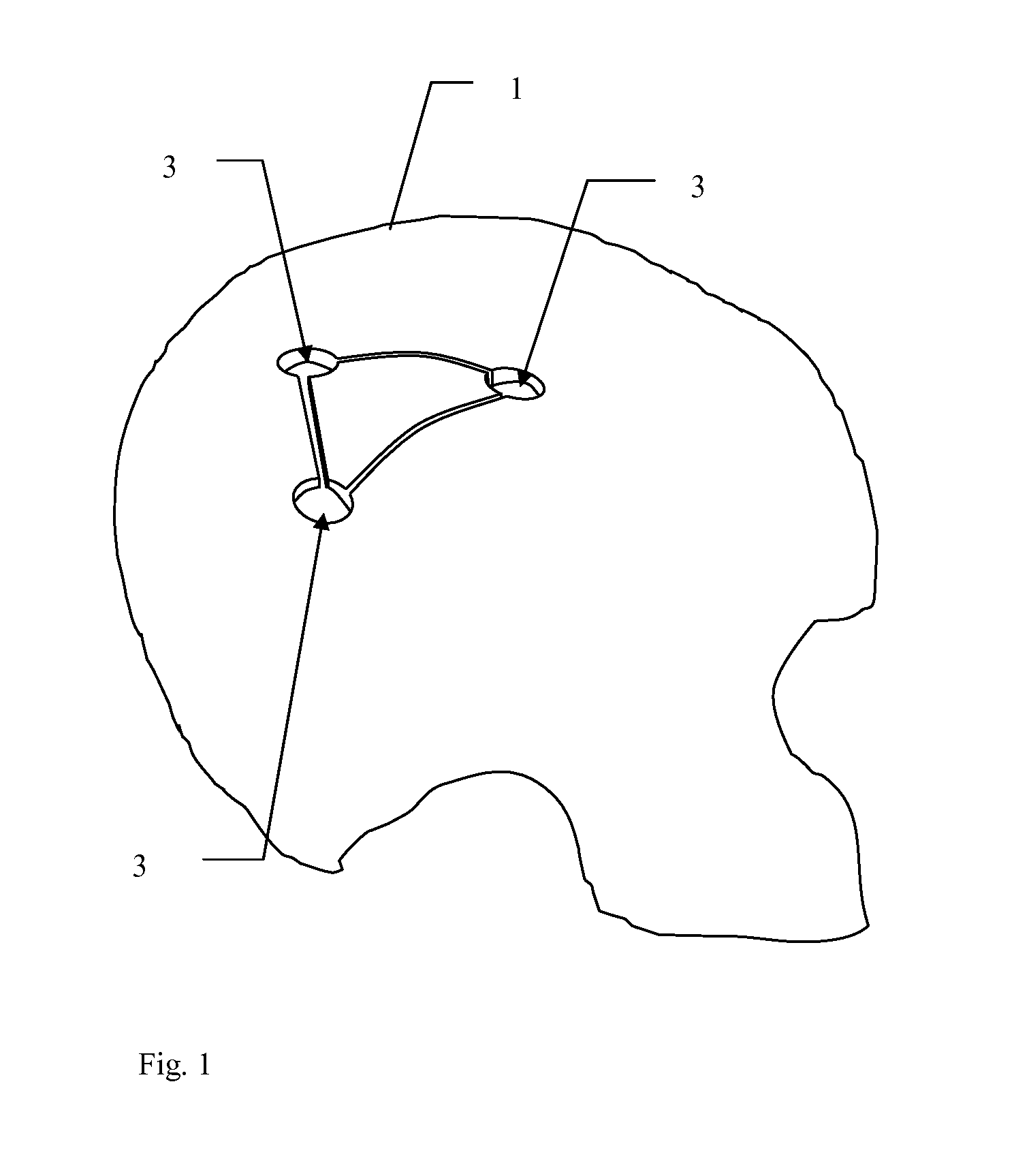 Implants and methods for using such implants to fill holes in bone tissue
