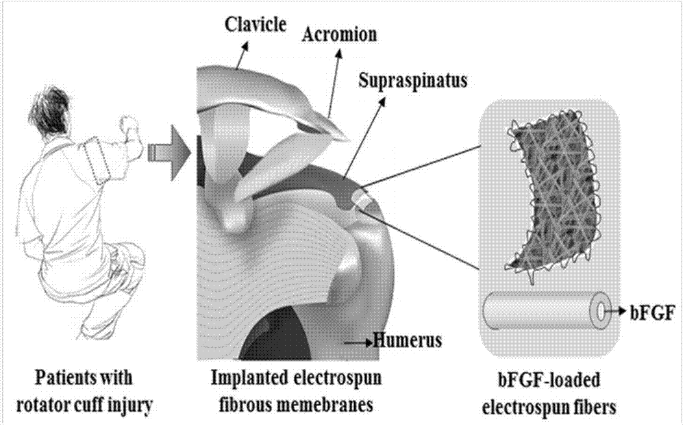 Application of nanofiber membrane in preparation of rotator cuff injury treatment material