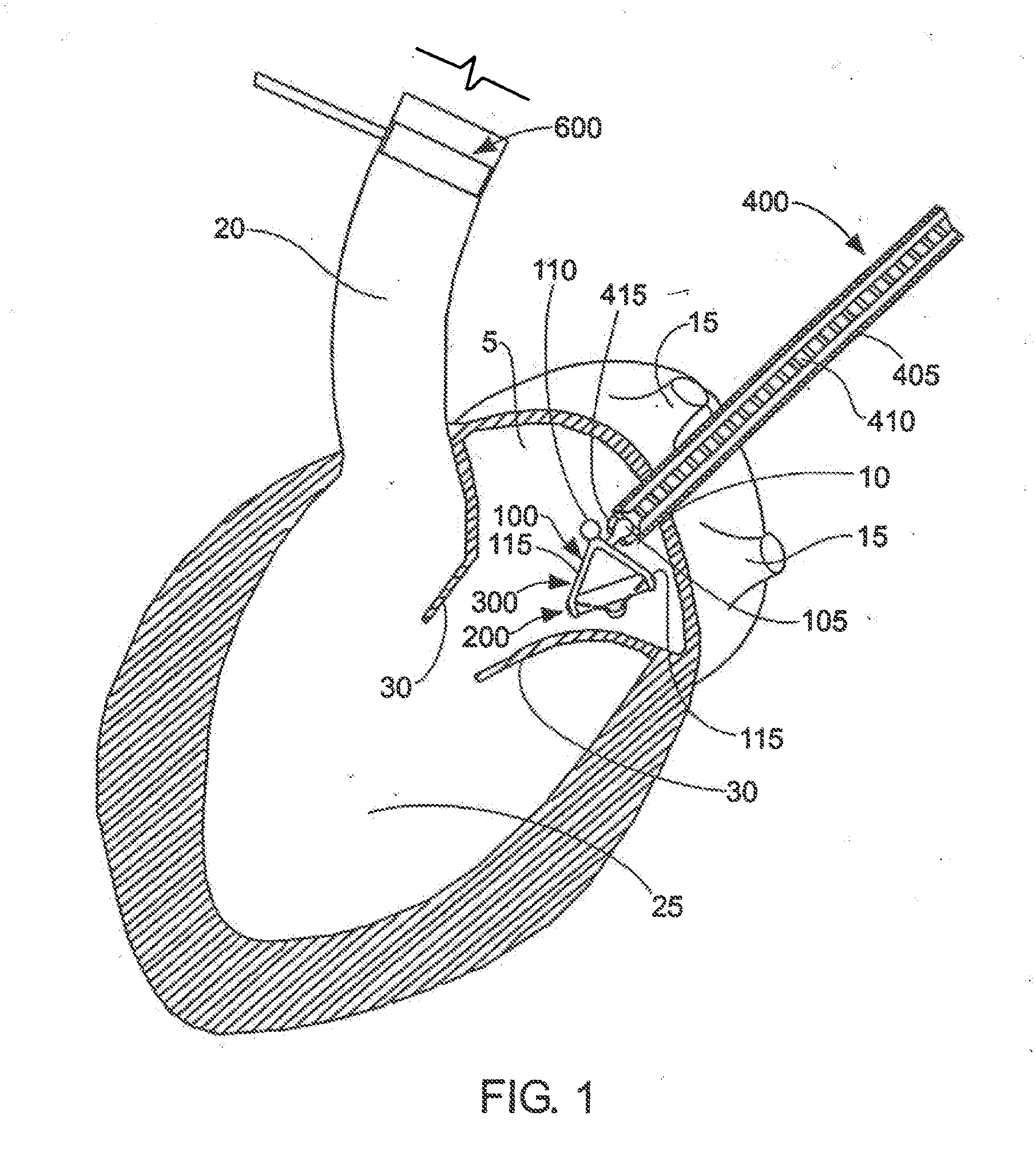 Apparatus for replacing a cardiac valve