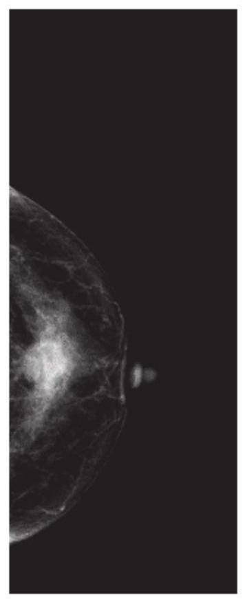 Intelligent mammary gland contrast enhancement photography classification system based on information bottleneck