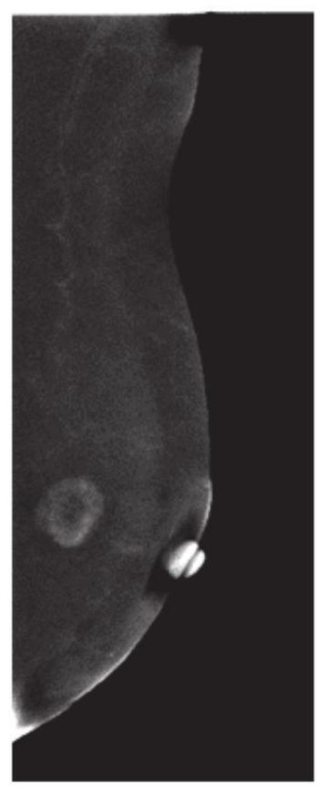 Intelligent mammary gland contrast enhancement photography classification system based on information bottleneck