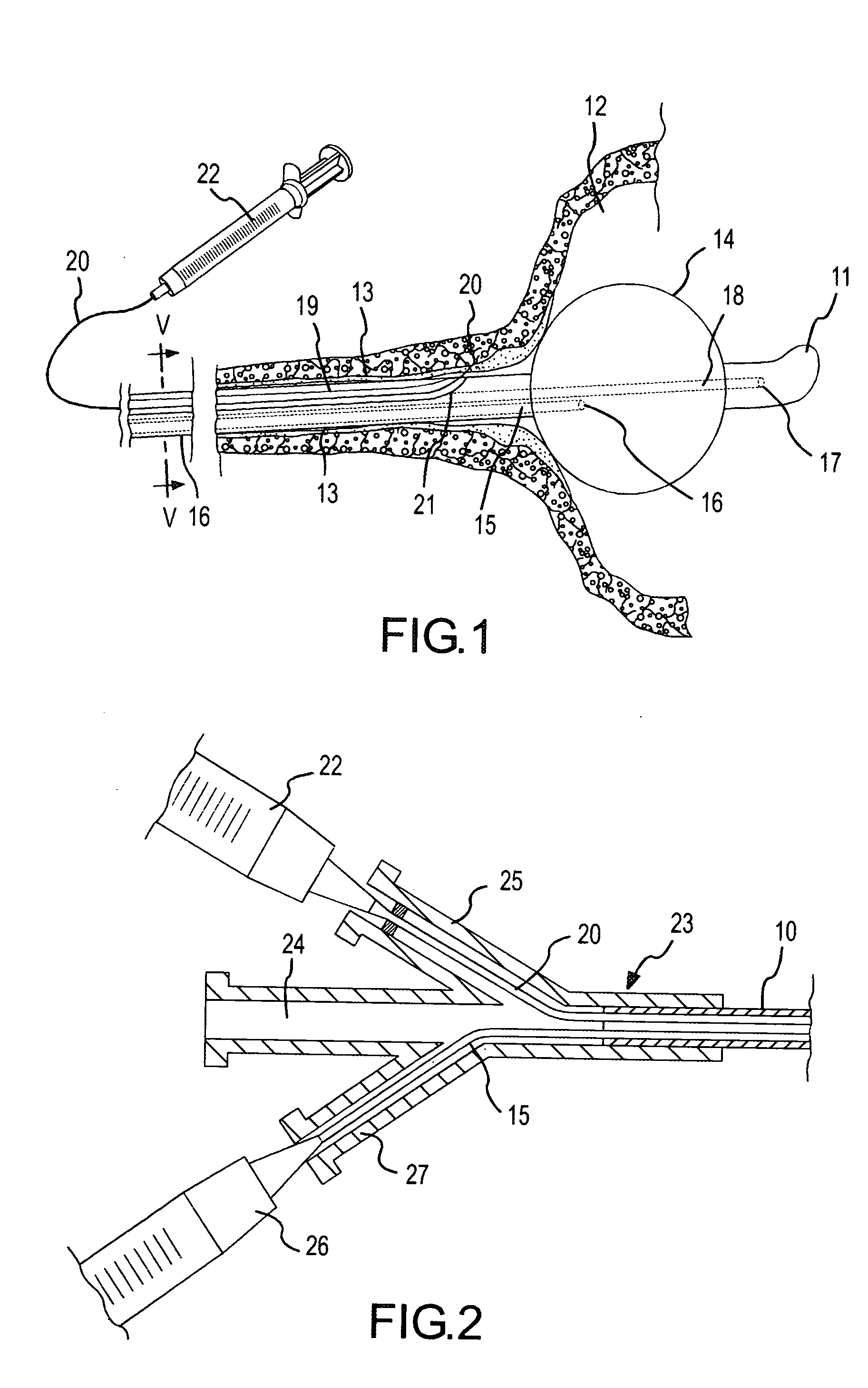 Method and device for the treatment of incontinence