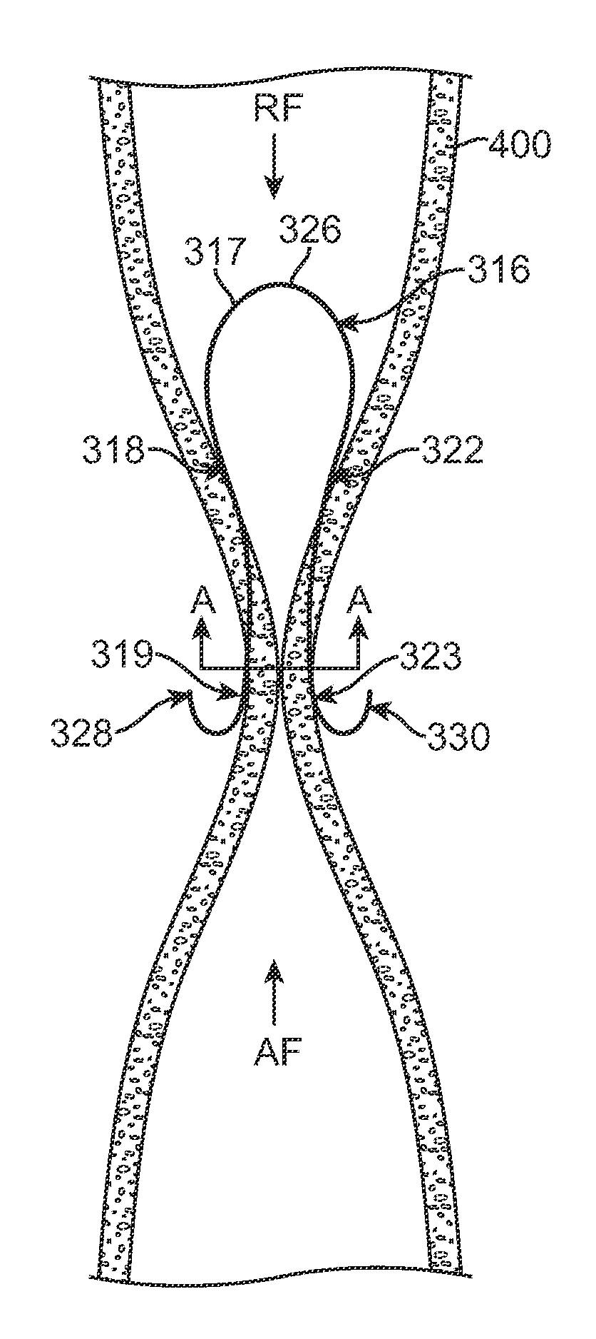Apparatus and Methods for Creating a Venous Valve From Autologous Tissue
