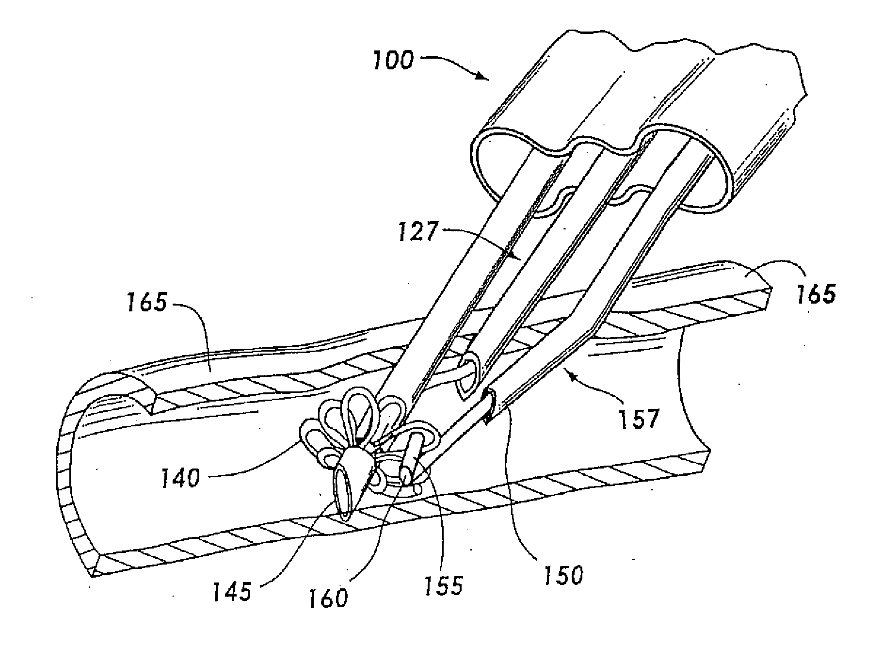 Three-needle closure device