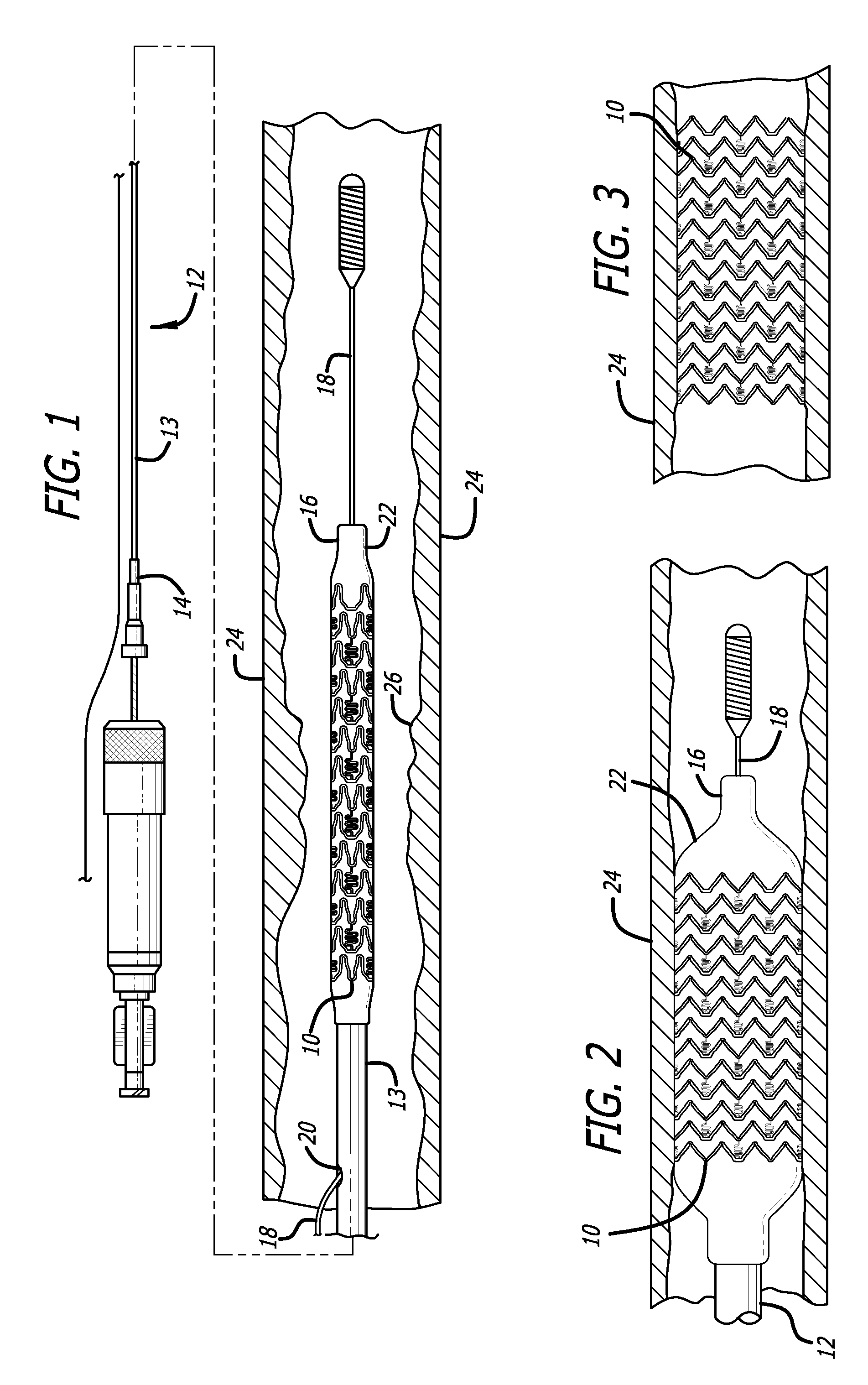 Electrochemical formation of foil-shaped stent struts
