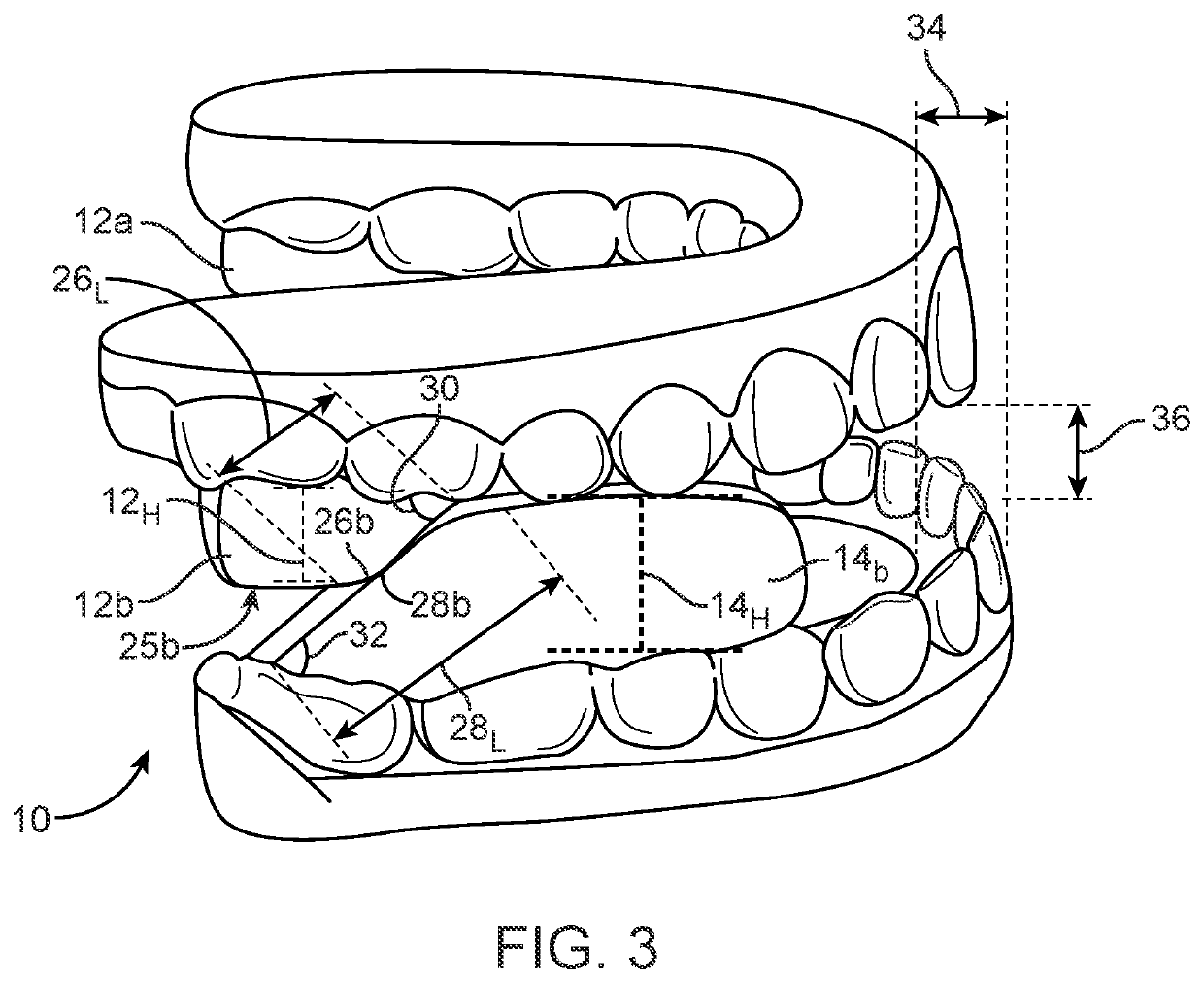 Combined orthodontic movement of teeth with airway development therapy