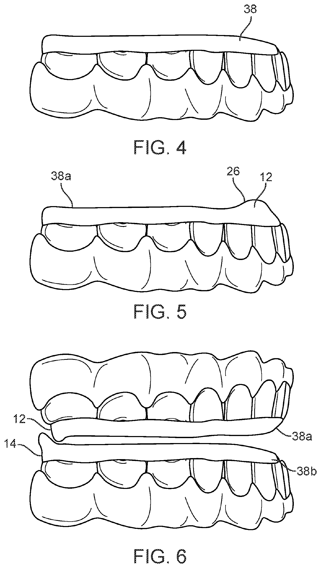 Combined orthodontic movement of teeth with airway development therapy