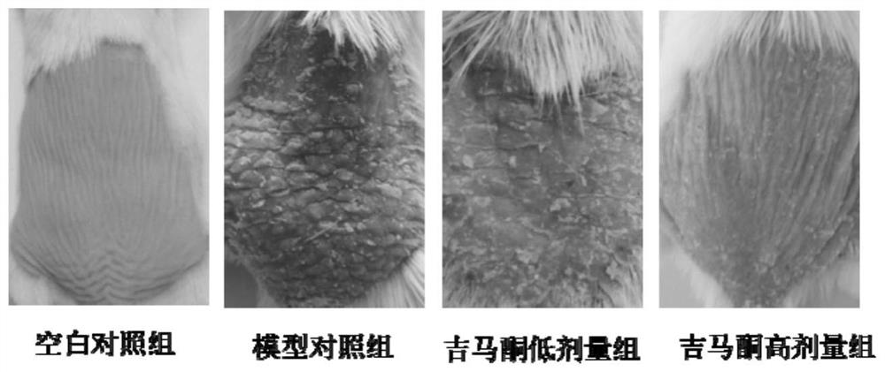 Application of gemmaconone in the preparation of medicines for preventing and treating psoriasis