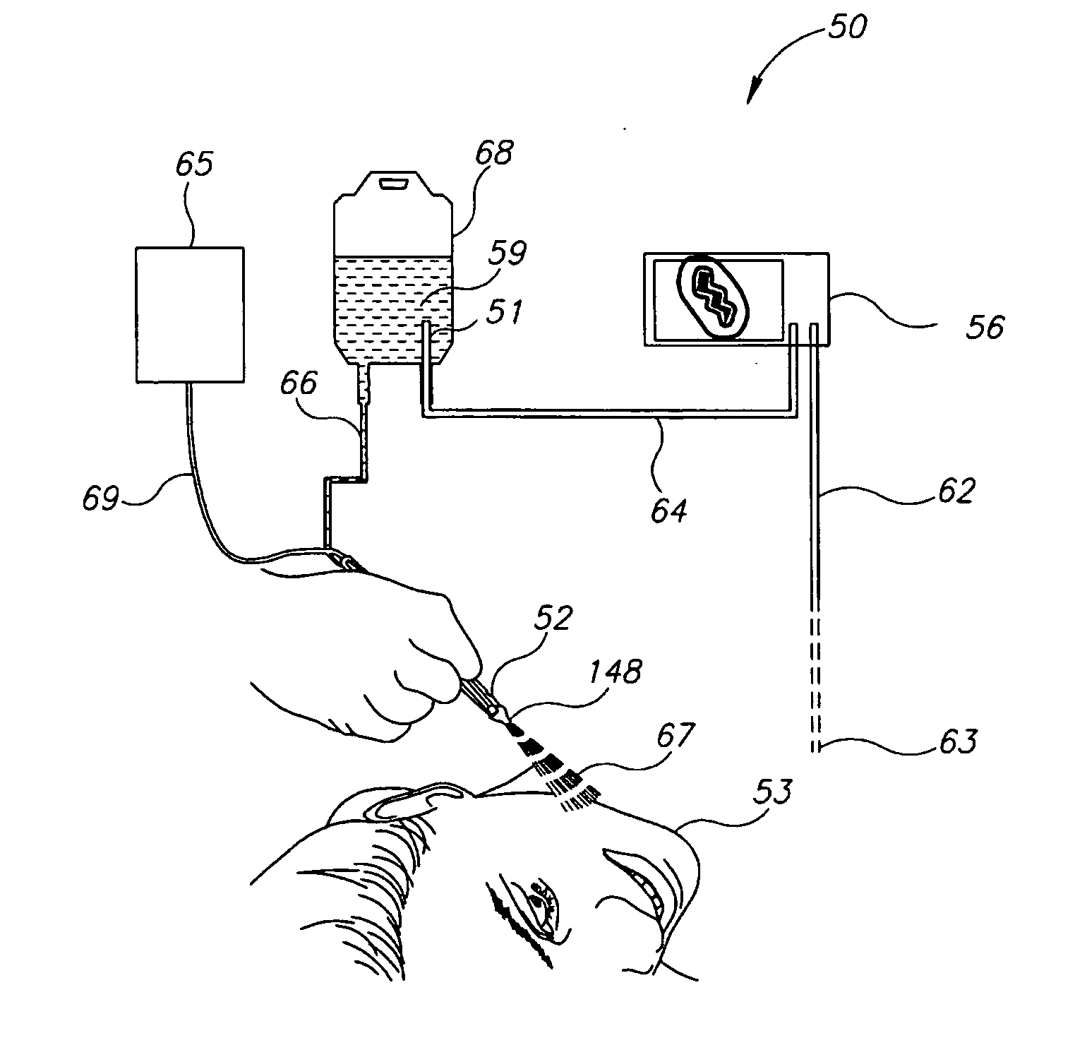System for tissue electroporation and method for use thereof