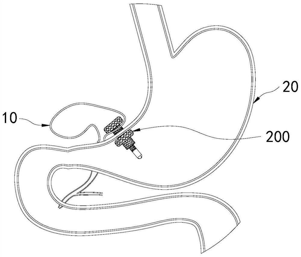 Anastomosis device