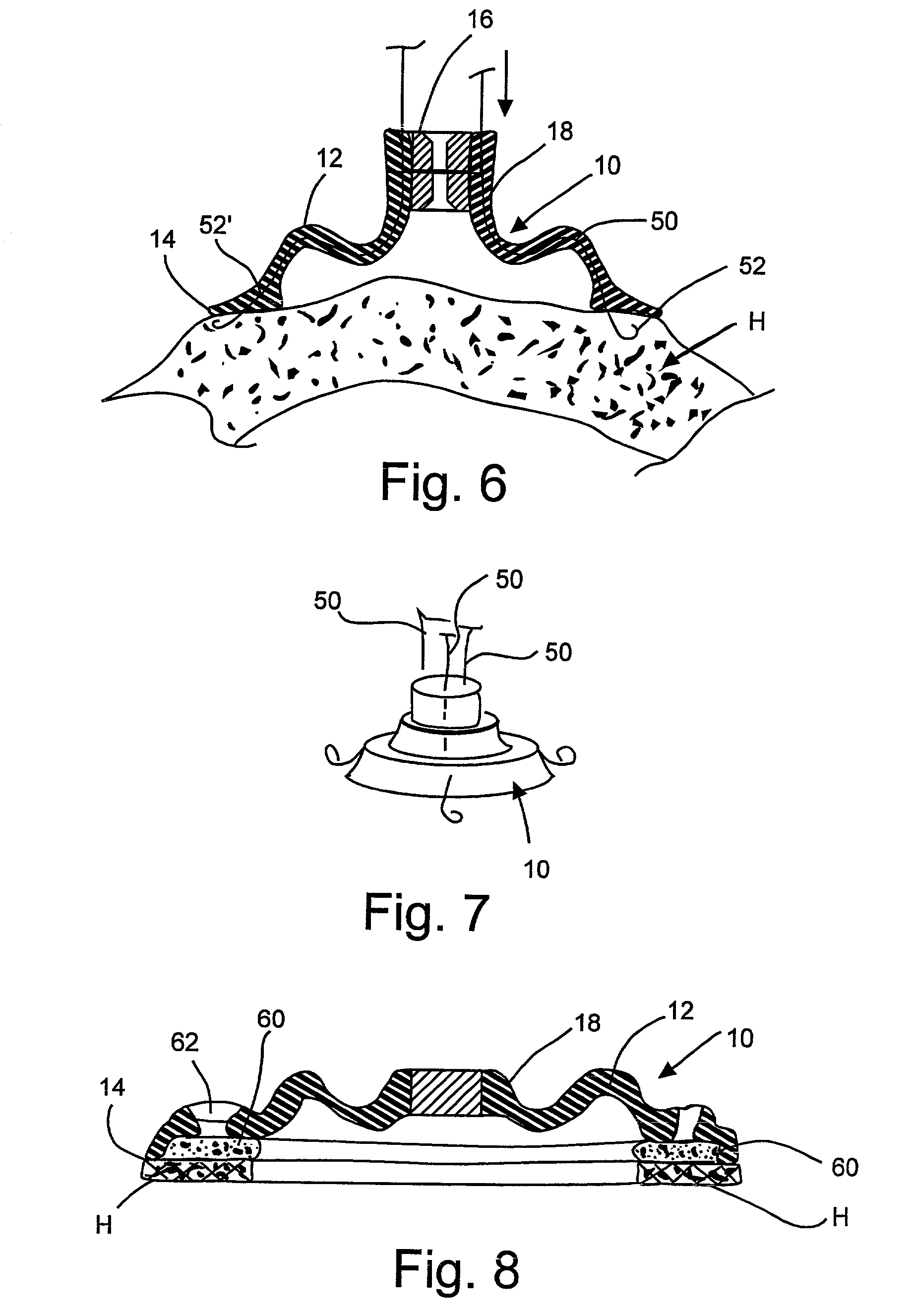 Device to permit offpump beating heart coronary bypass surgery