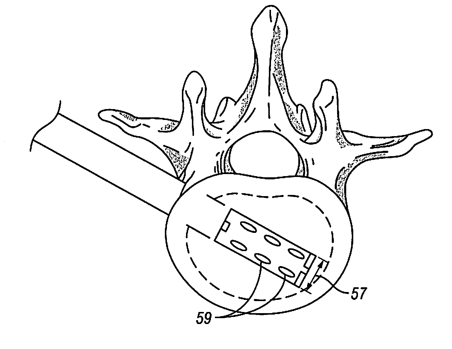 Devices and Methods for Treating Bone