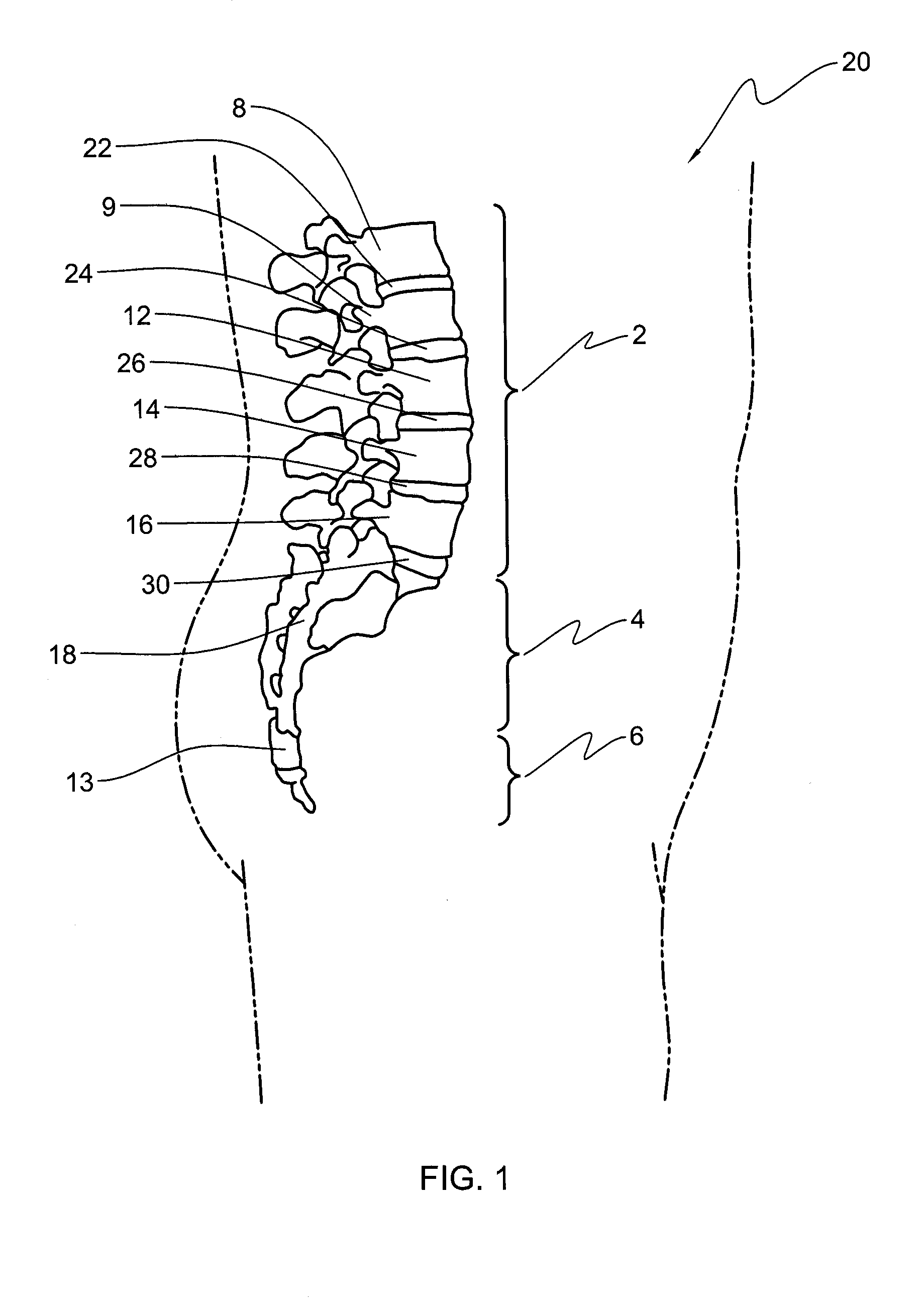 Spinal implant system
