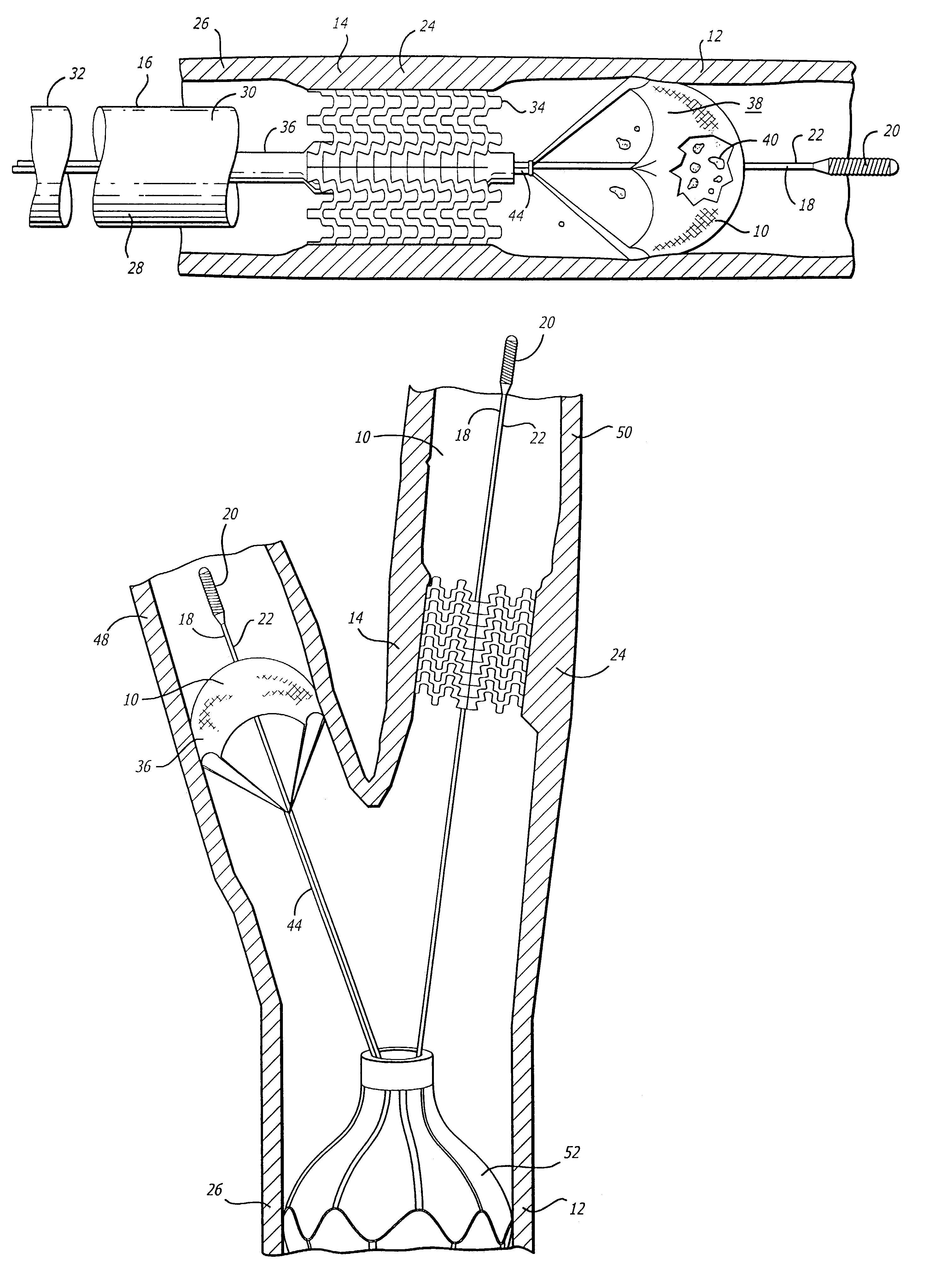 Vessel occlusion device for embolic protection system