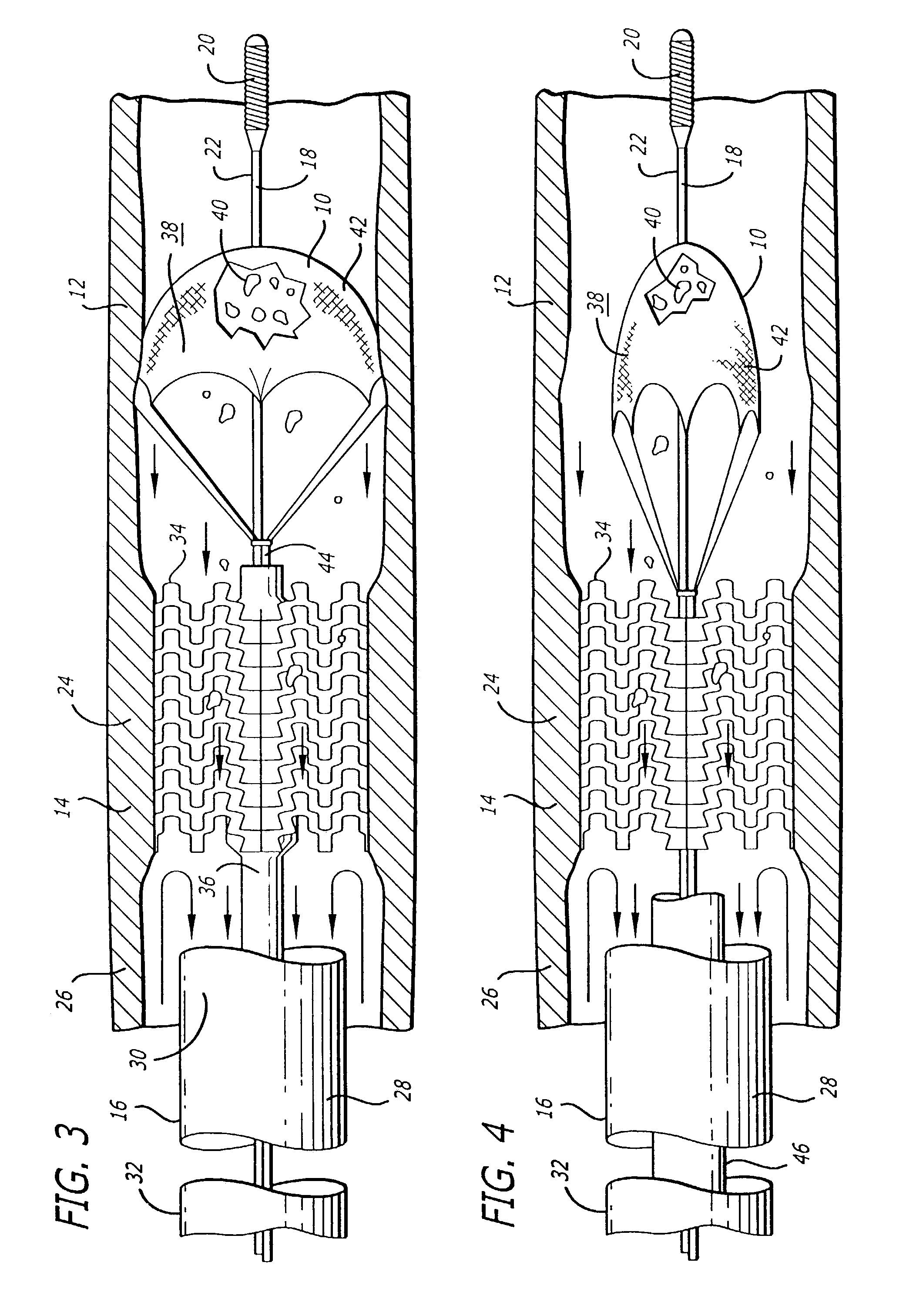 Vessel occlusion device for embolic protection system