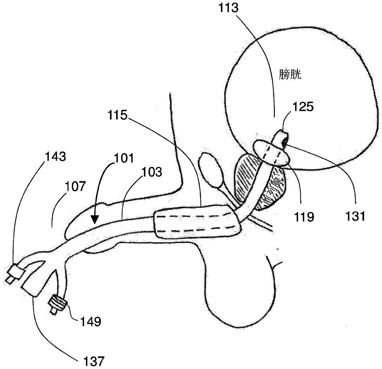 Urethral balloon dilator catheter