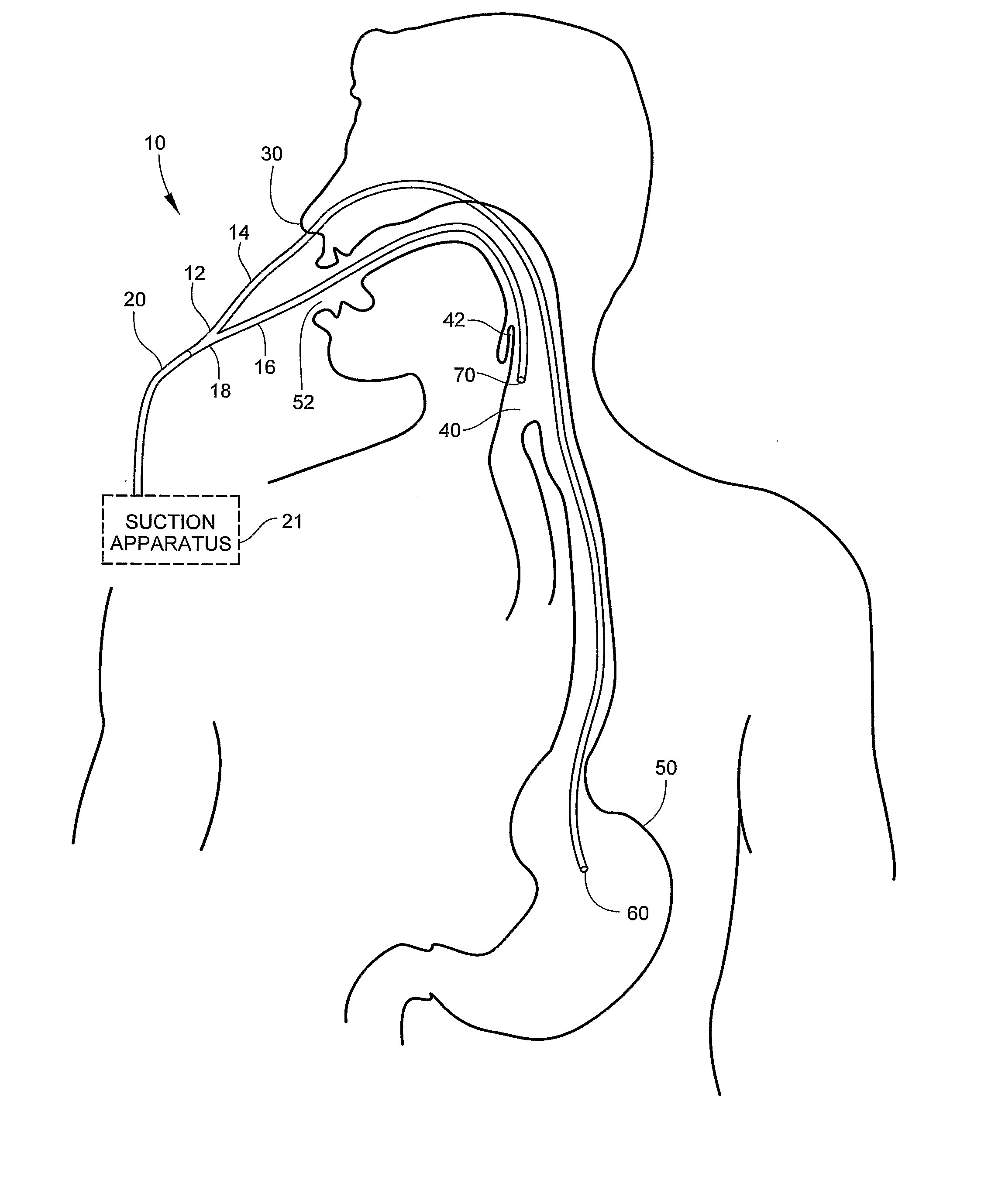 Medical Apparatus with Hypropharyngeal Suctioning Capability