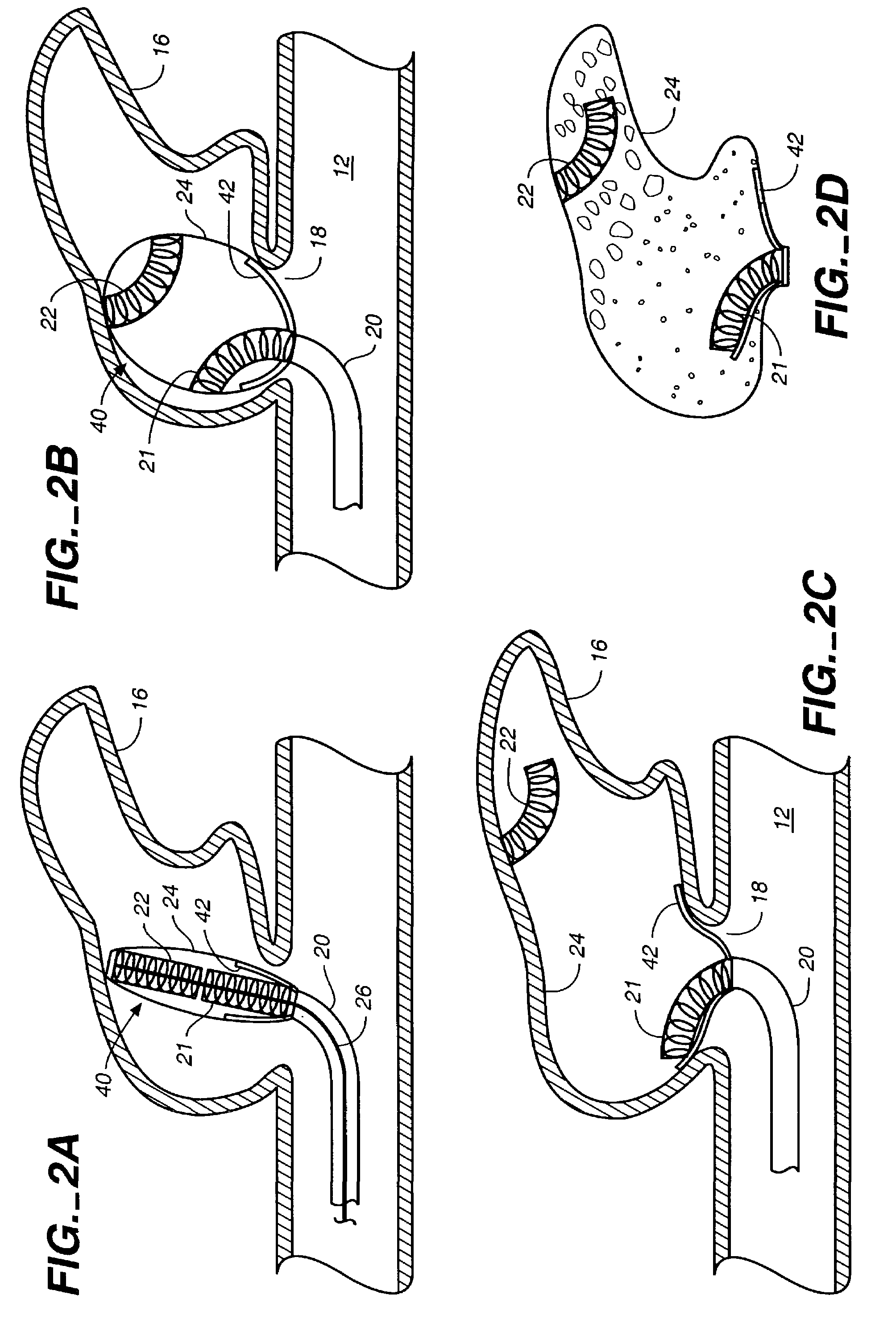 Expandable body cavity liner device