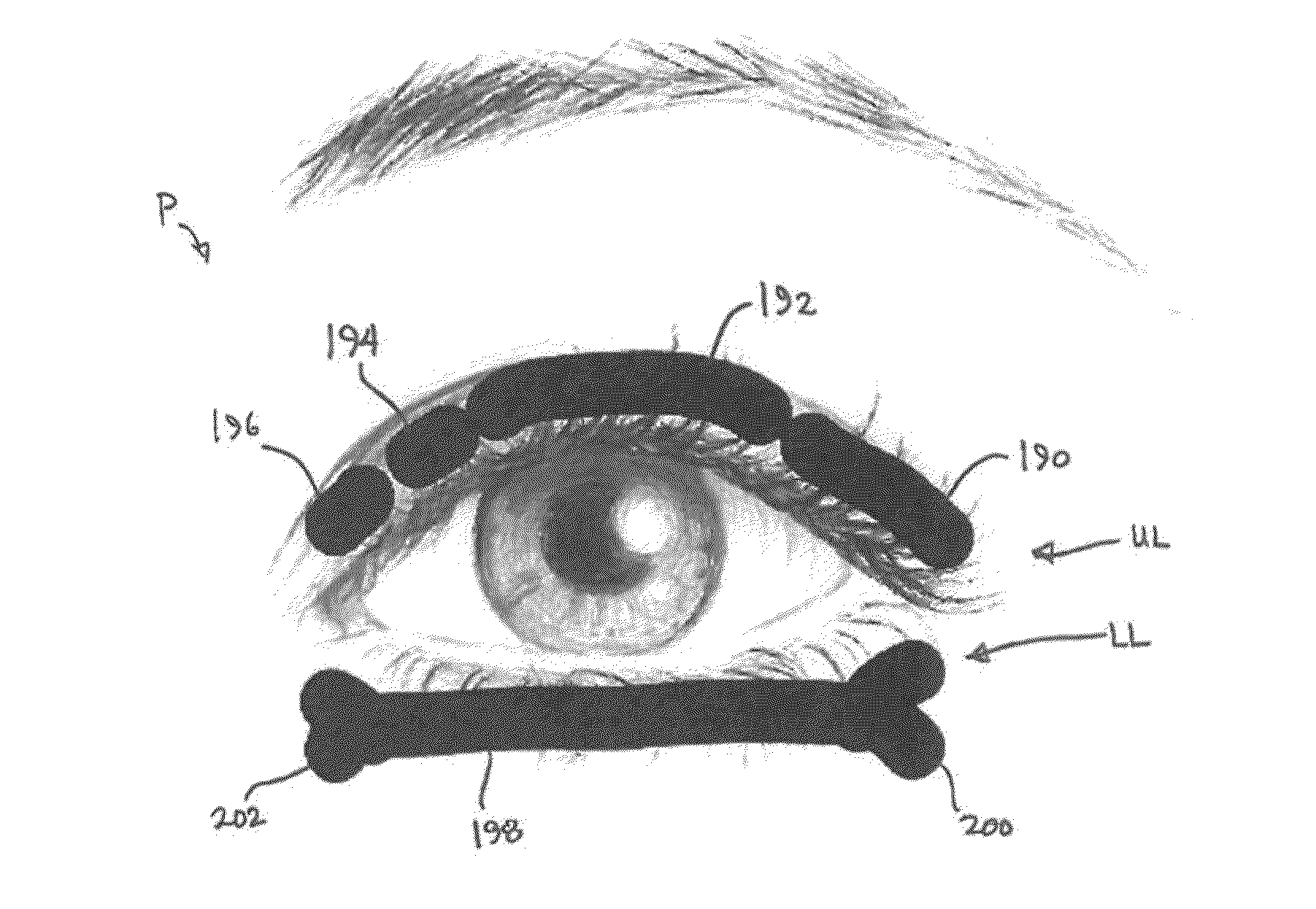 Dry eye treatment apparatus and methods