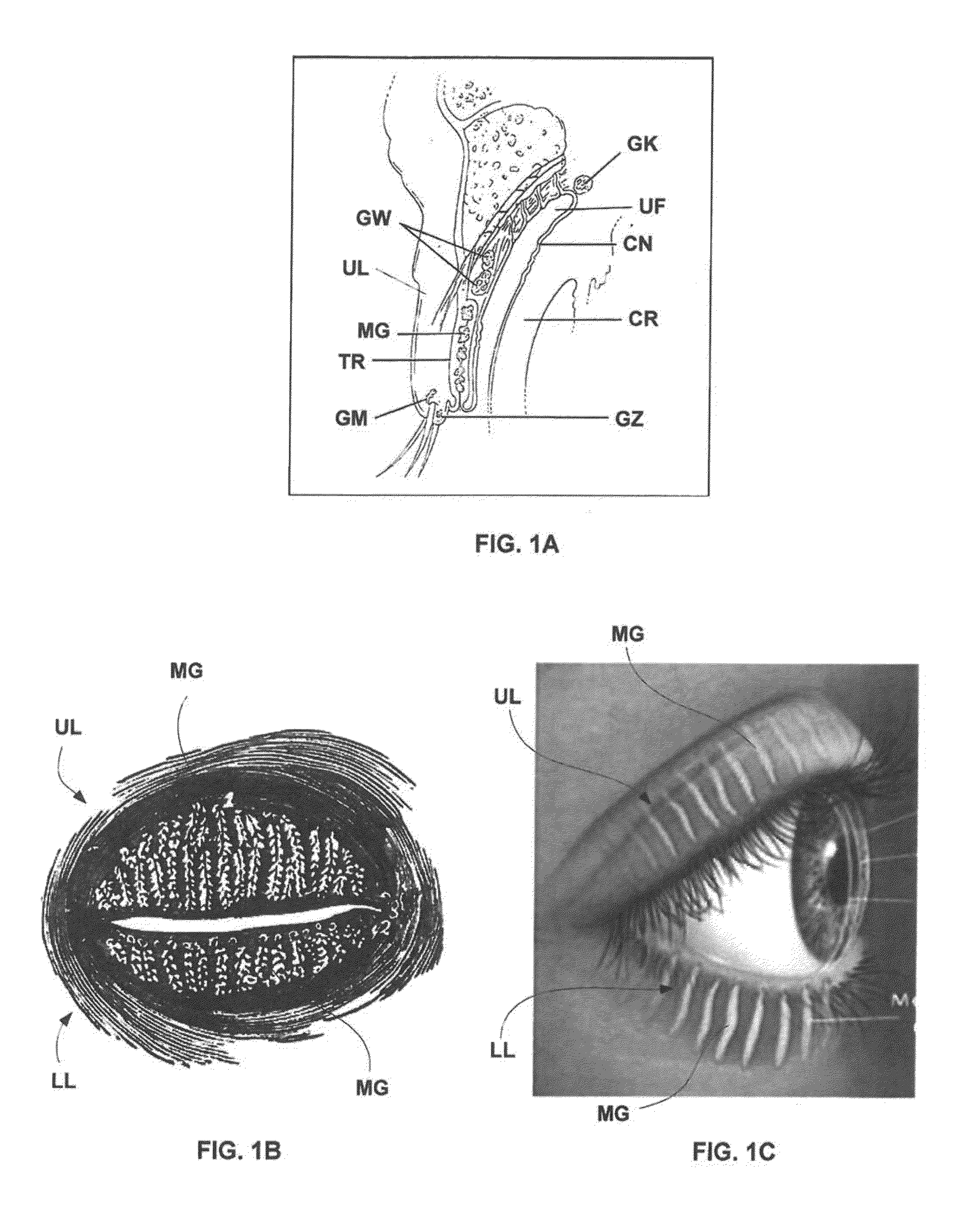 Dry eye treatment apparatus and methods