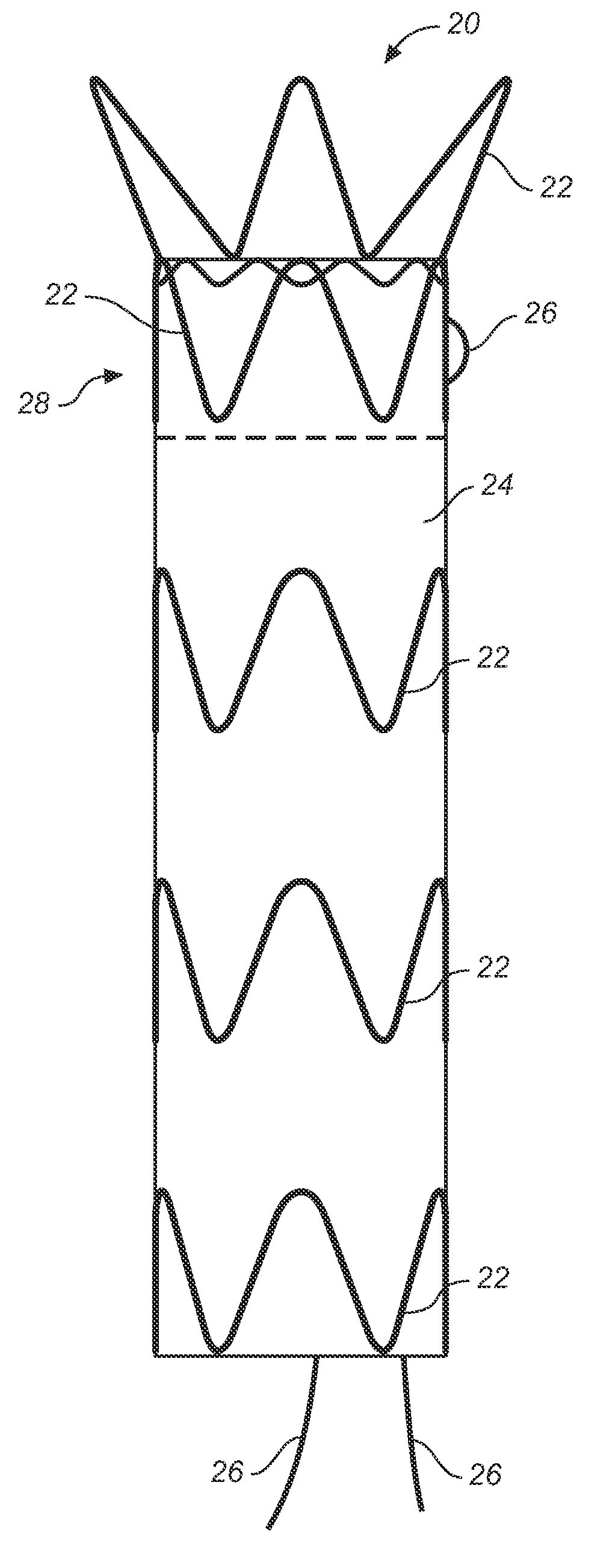 Stent graft fixation system and method
