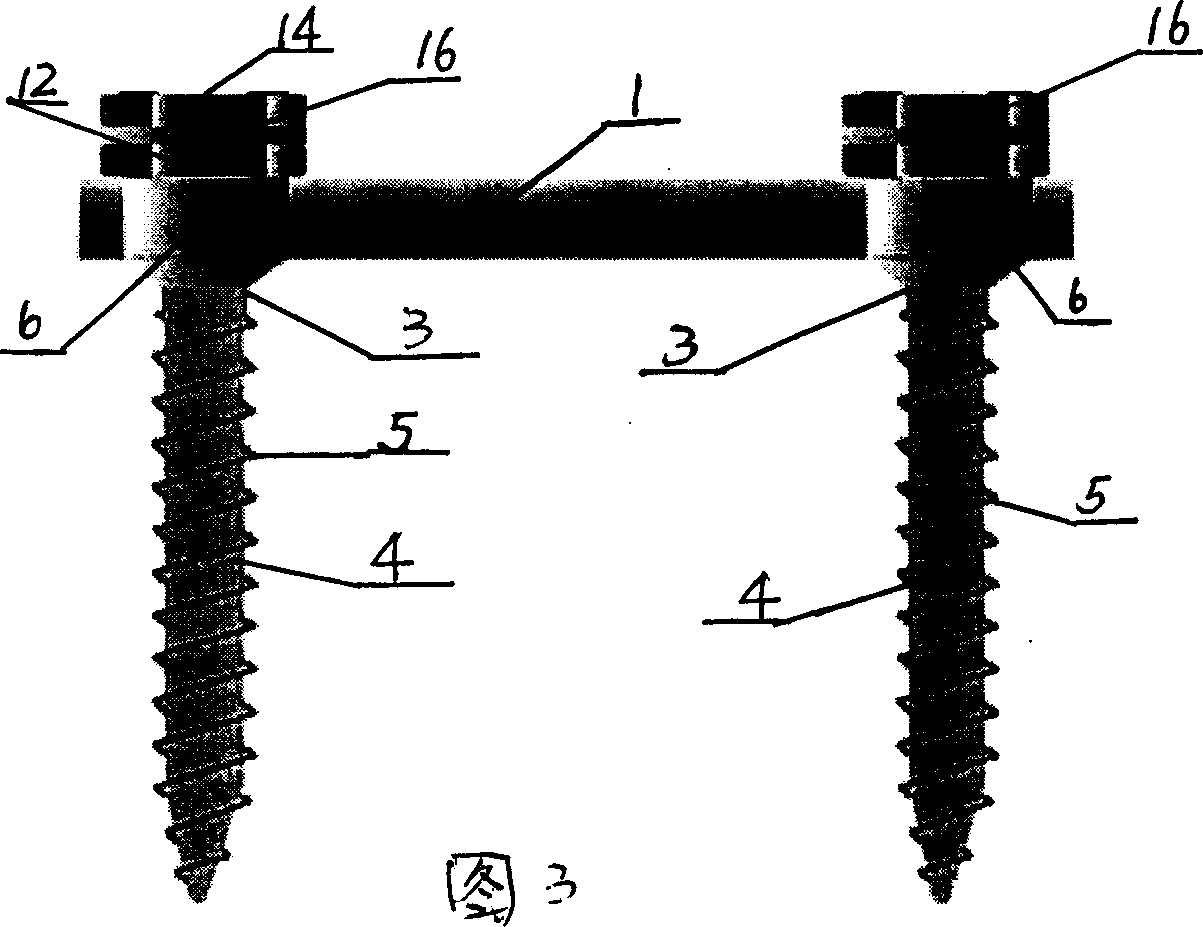 Pier bridge style screw system for vertebral arch pedicle