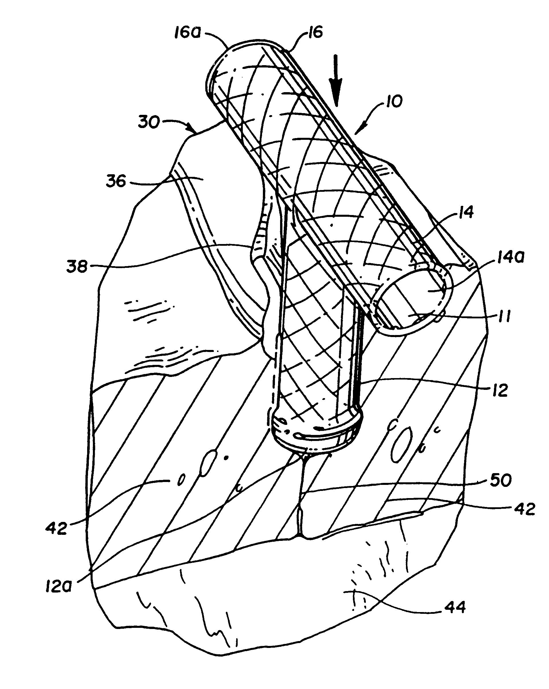 Expandable myocardial implant