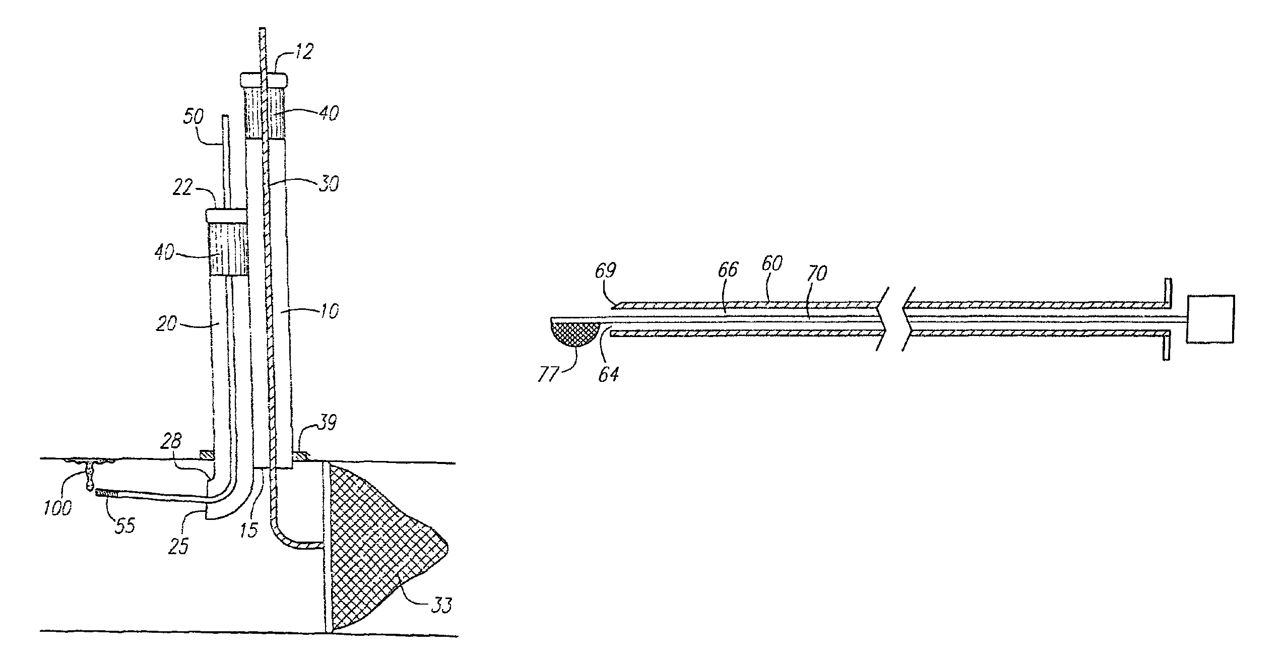 Direct access atherectomy devices and methods of use