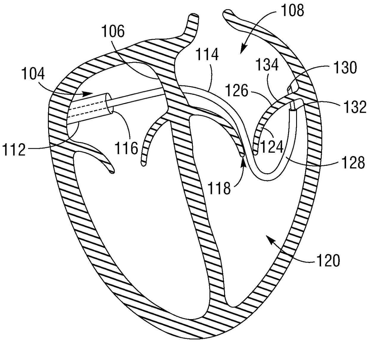 Posterior mitral valve leaflet approximation