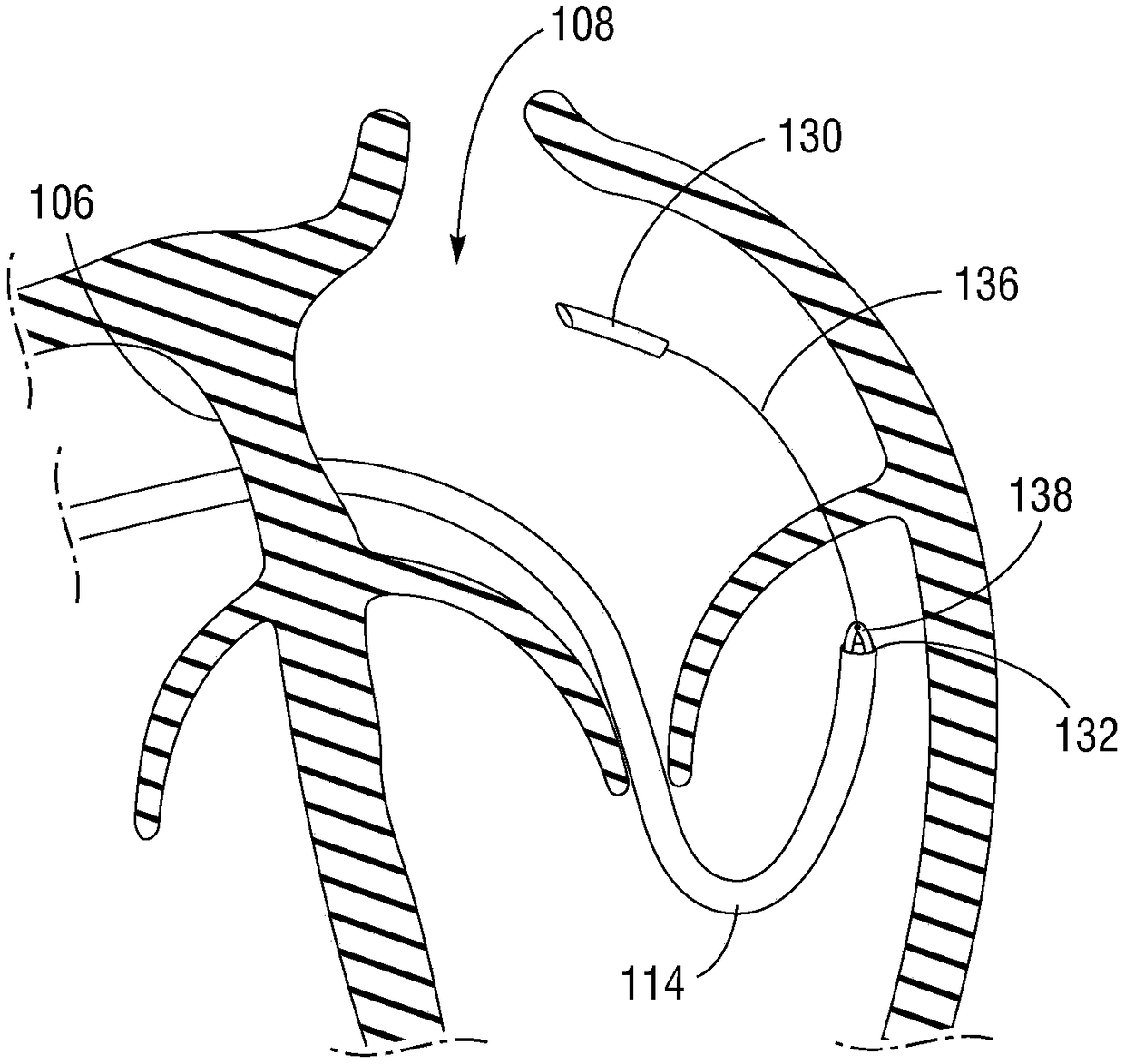 Posterior mitral valve leaflet approximation