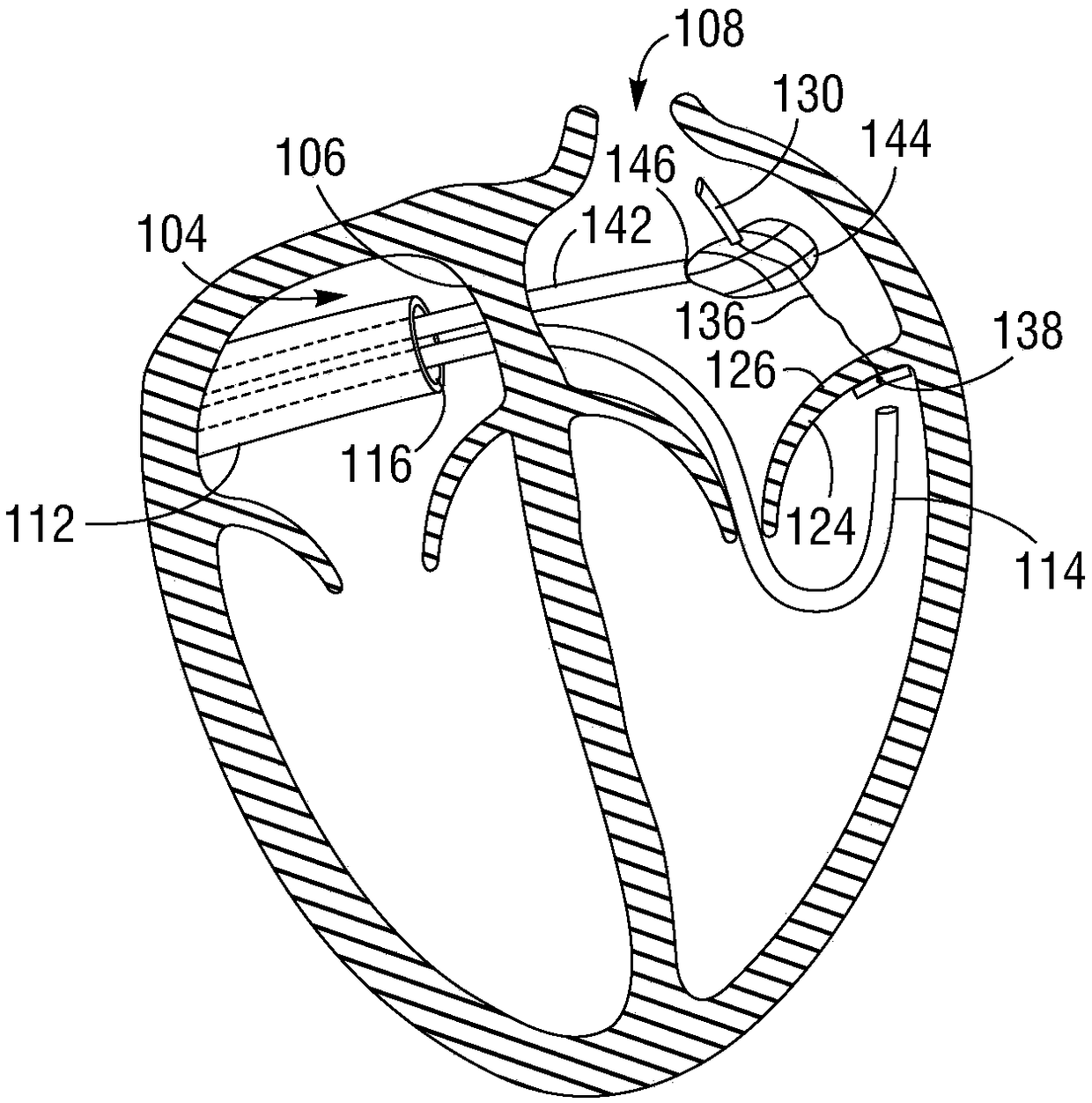 Posterior mitral valve leaflet approximation