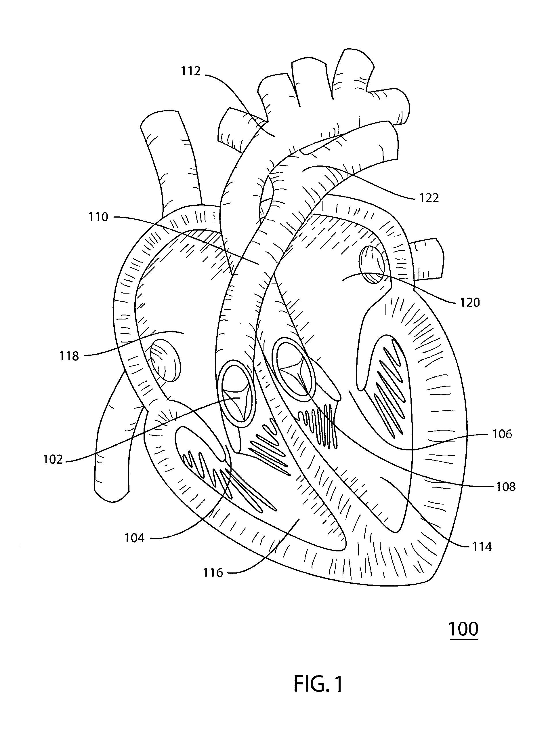 Reinforced Surgical Conduit for Implantation of a Stented Valve Therein