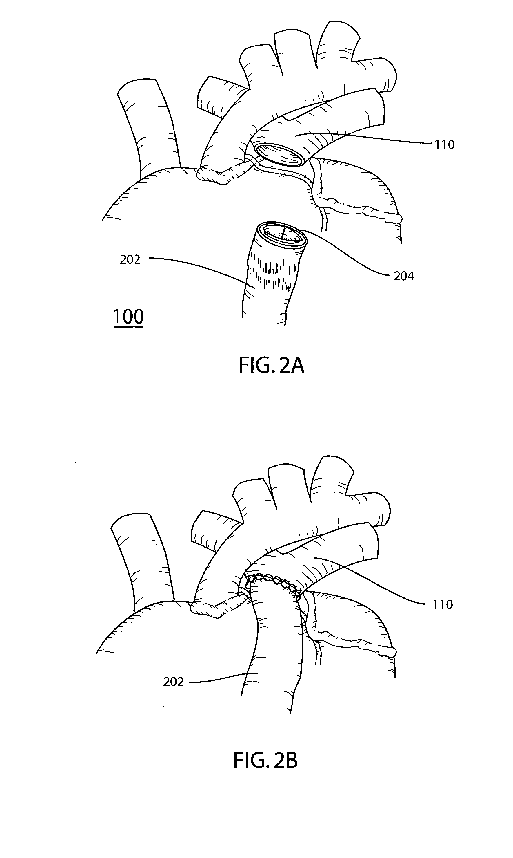 Reinforced Surgical Conduit for Implantation of a Stented Valve Therein