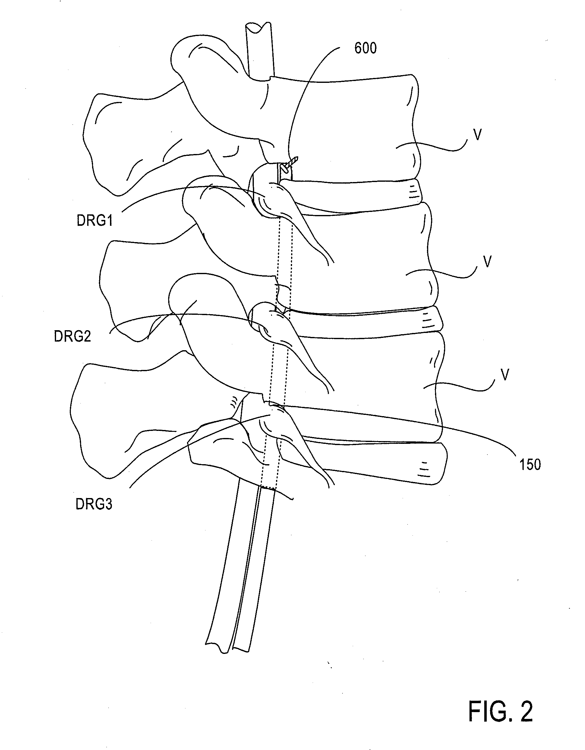 Hard tissue anchors and delivery devices