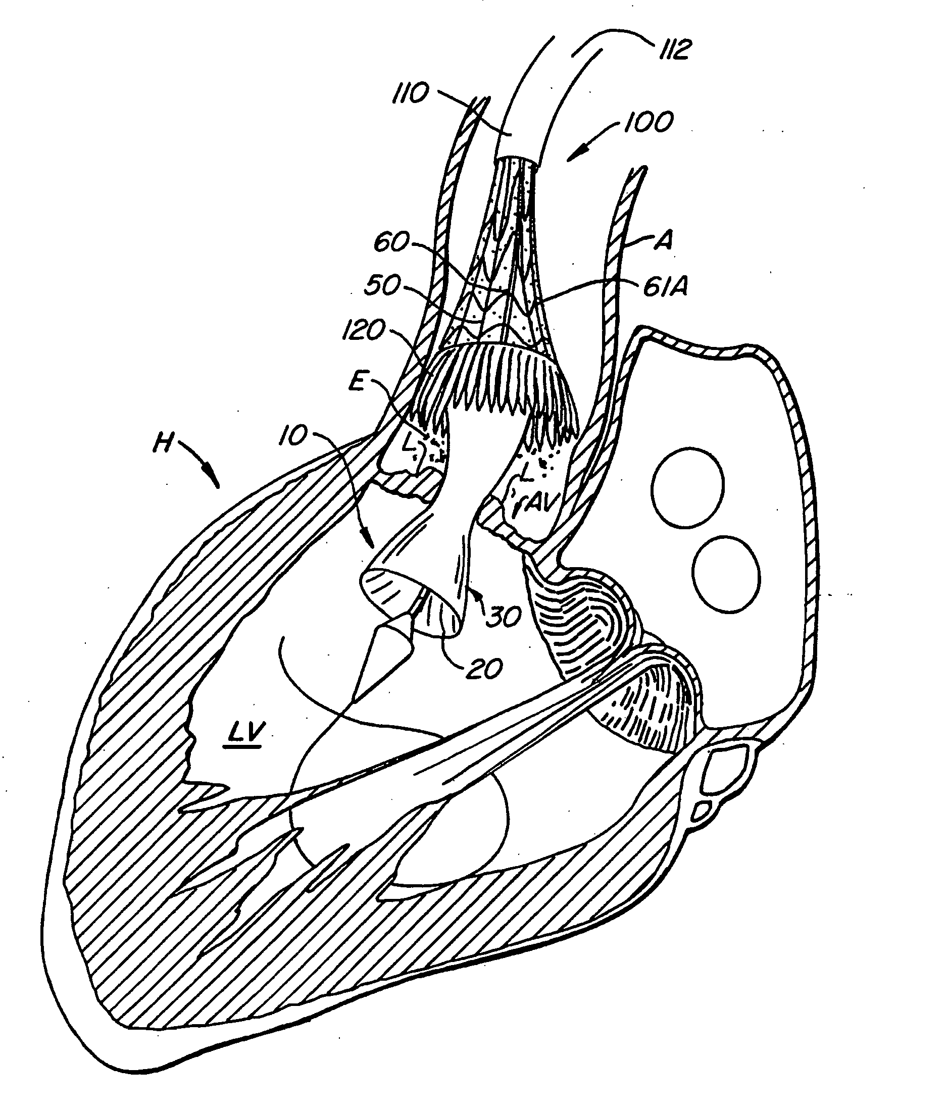 Apparatus and methods for protecting against embolization during endovascular heart valve replacement