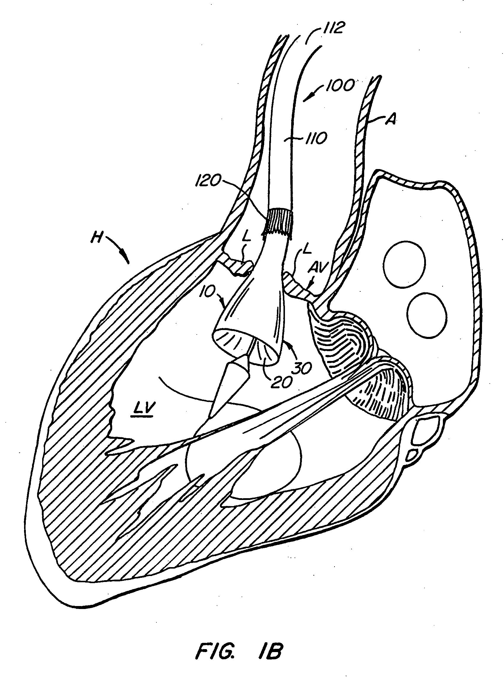 Apparatus and methods for protecting against embolization during endovascular heart valve replacement