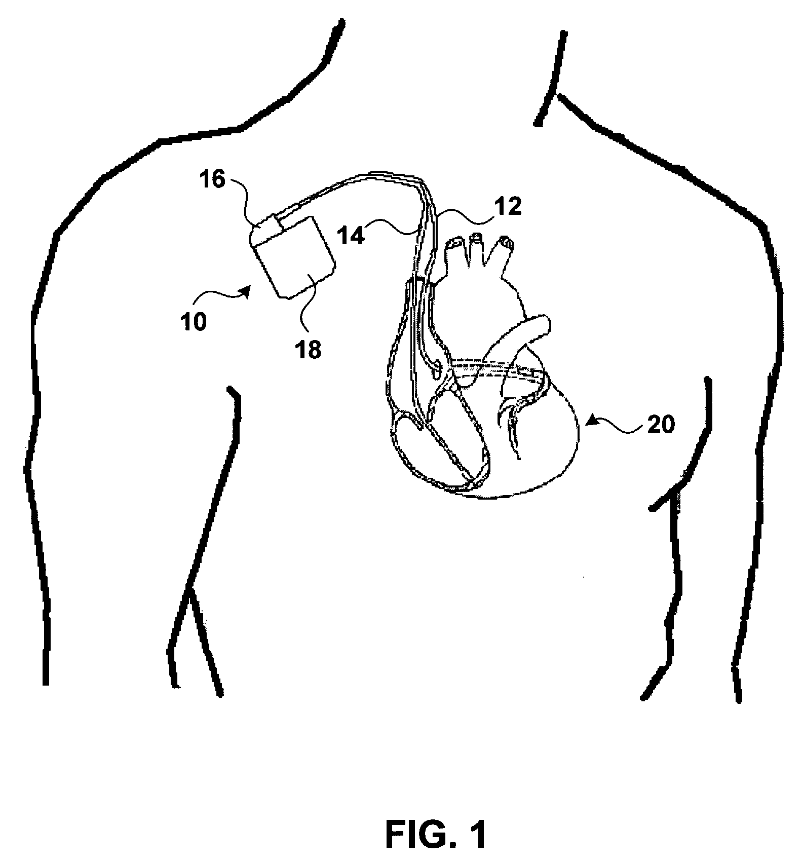 Bi-ventricular and single-ventricle pacing