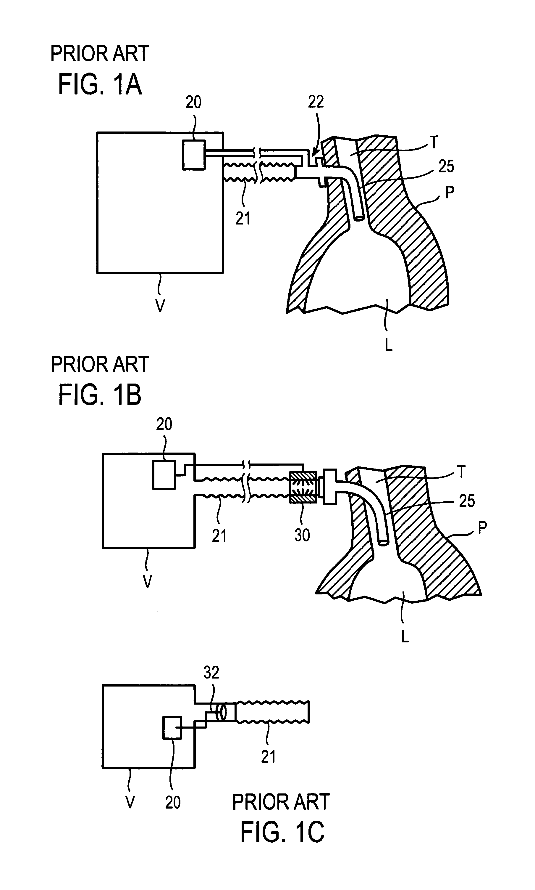 Methods and devices for sensing respiration and providing ventilation therapy