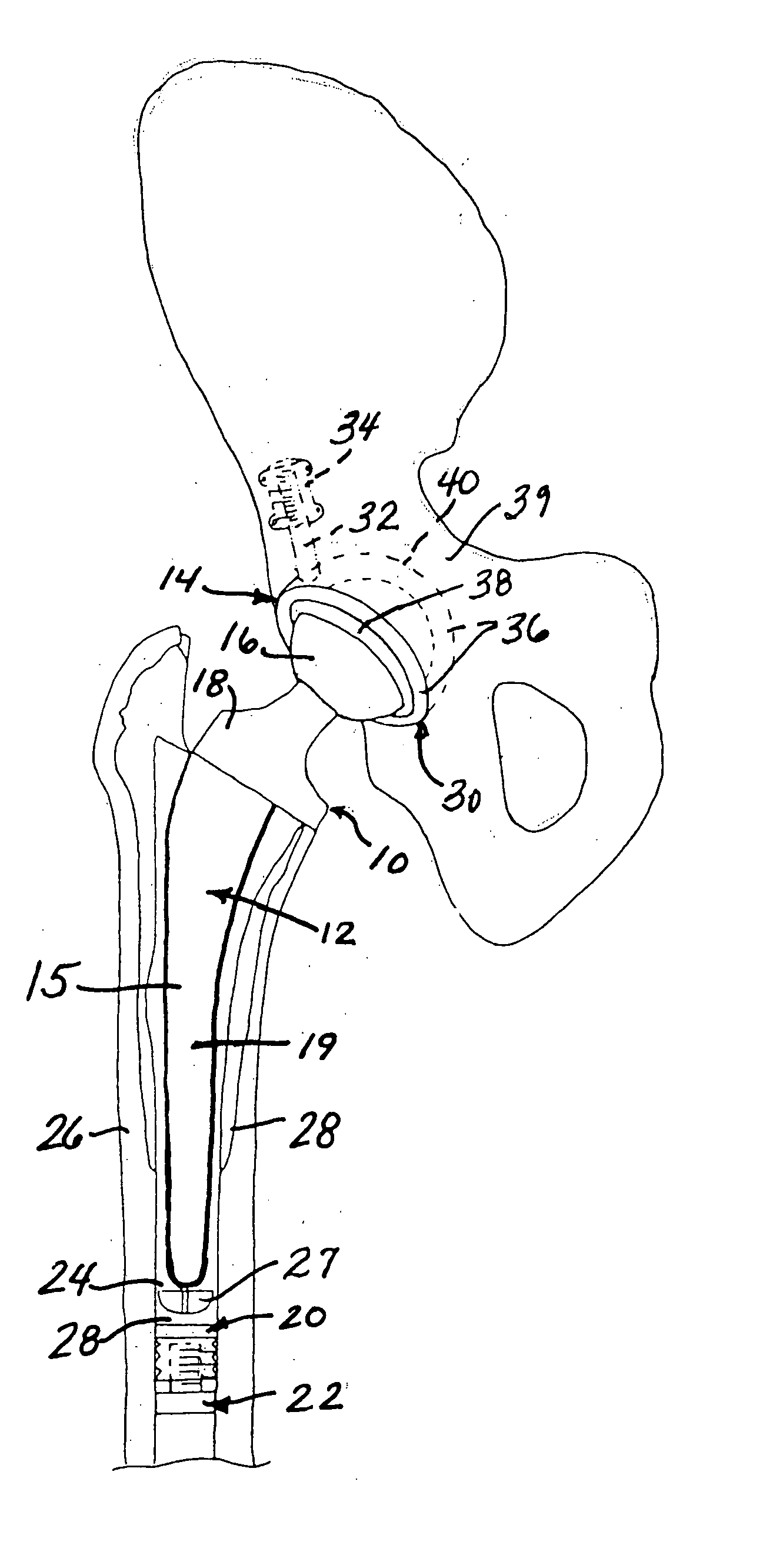 Implant system with migration measurement capacity