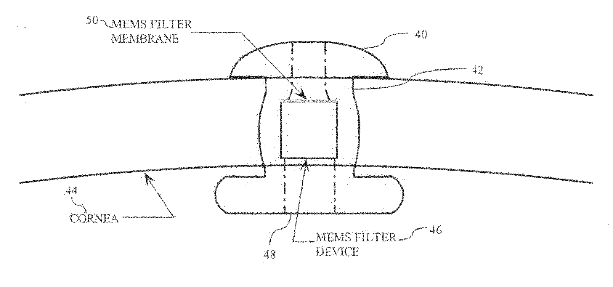 Micromachined membrane filter device for a glaucoma implant and method for making the same