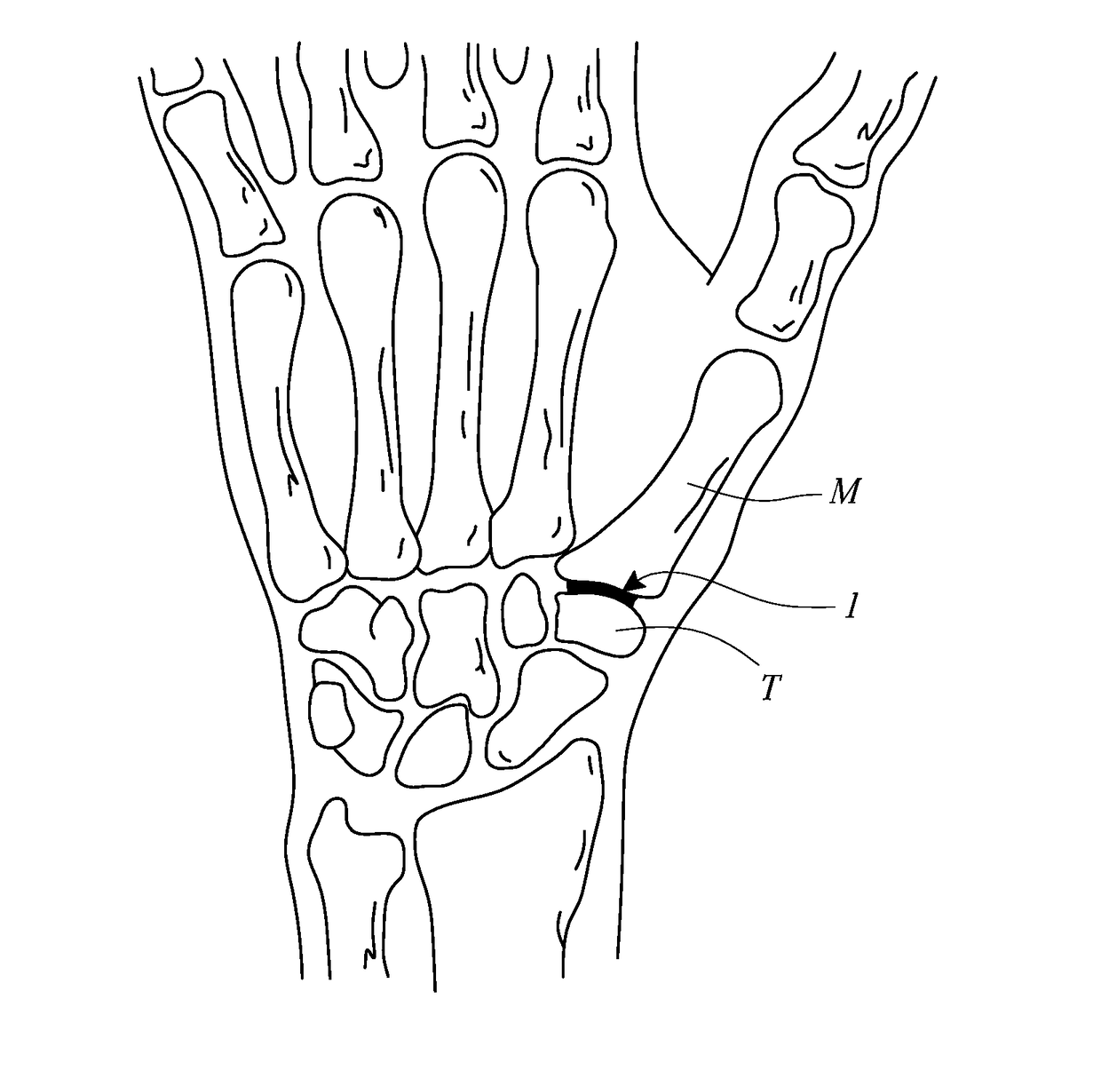 Trapeziometacarpal joint implant and associated methods