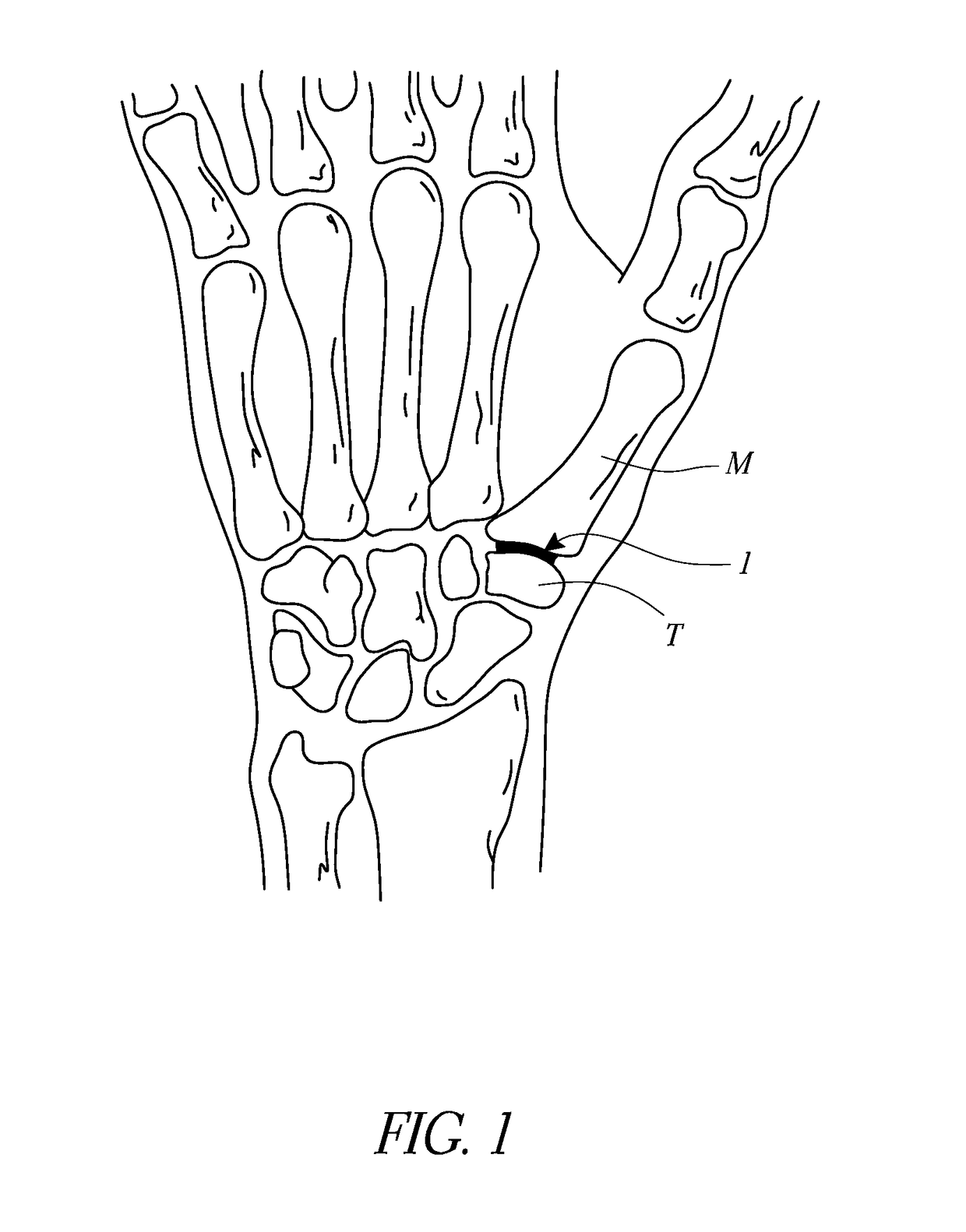 Trapeziometacarpal joint implant and associated methods