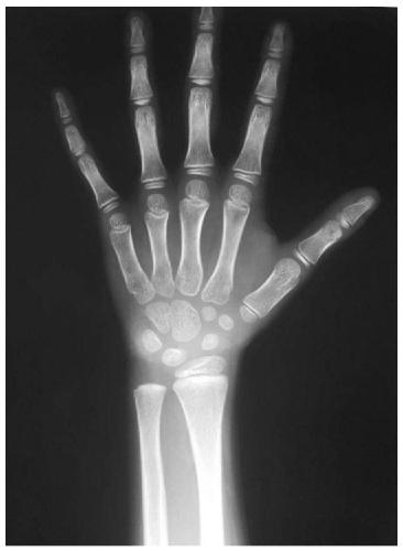 Method for determining developmental grade of hand epiphysis and related equipment