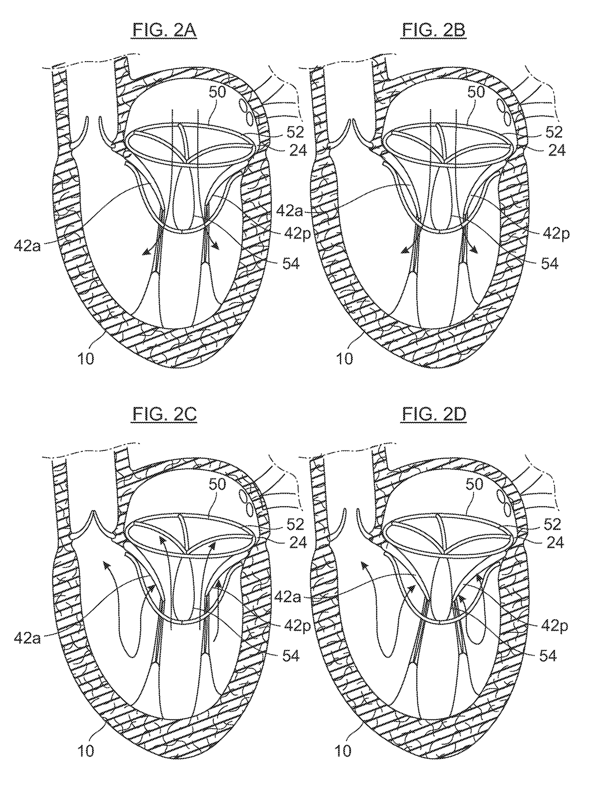 Axisymmetric adjustable device for treating mitral regurgitation