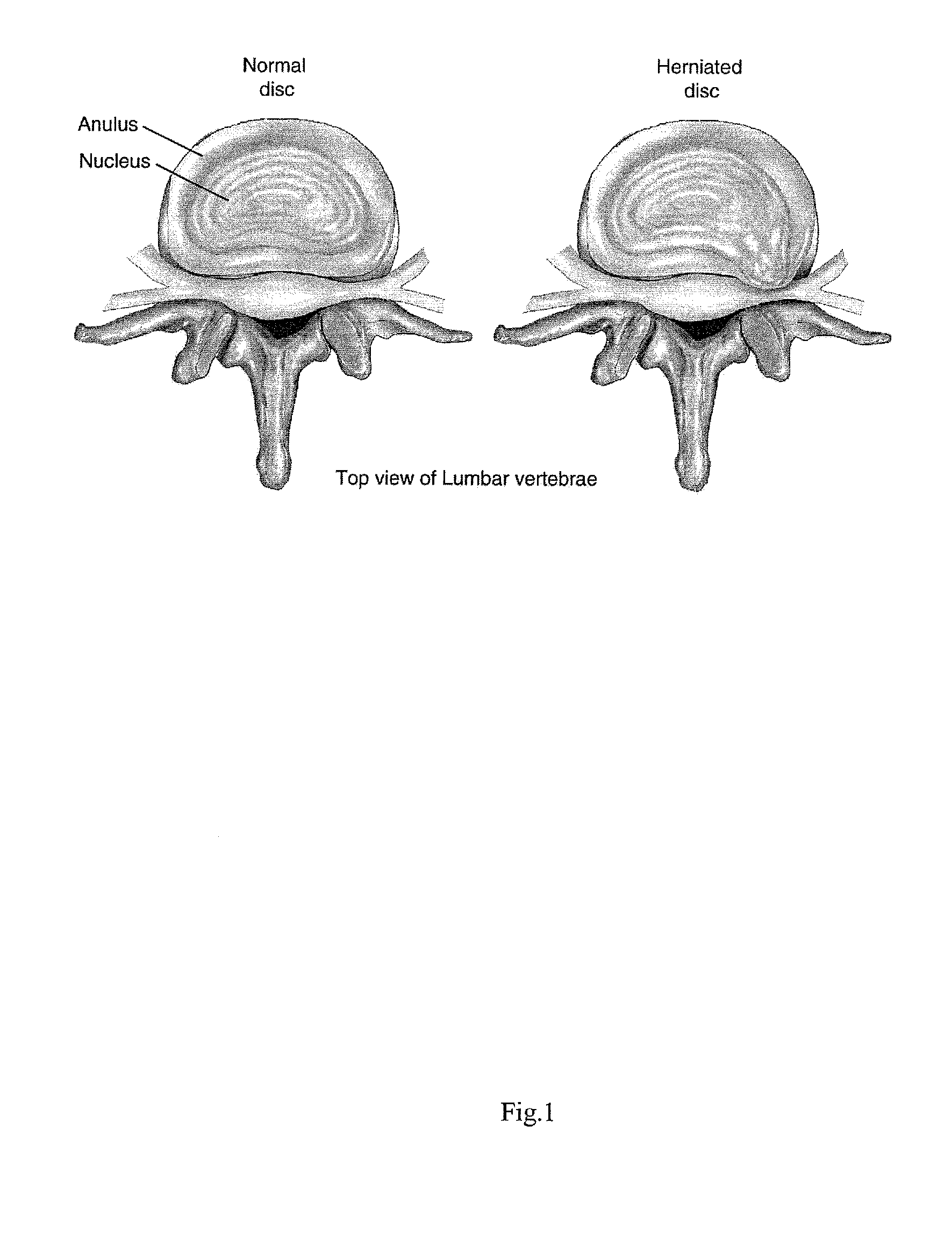 Intervertebral disc repair, methods and devices therefor