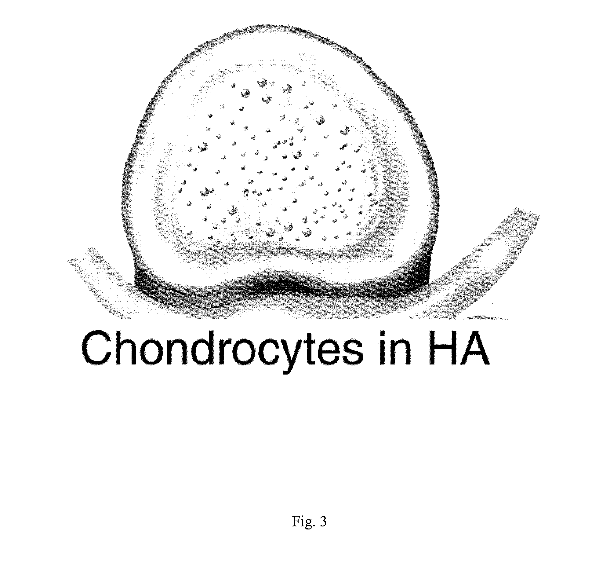 Intervertebral disc repair, methods and devices therefor